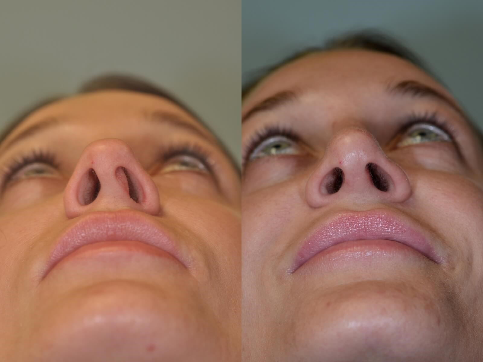 Rhinoplasty Before and After