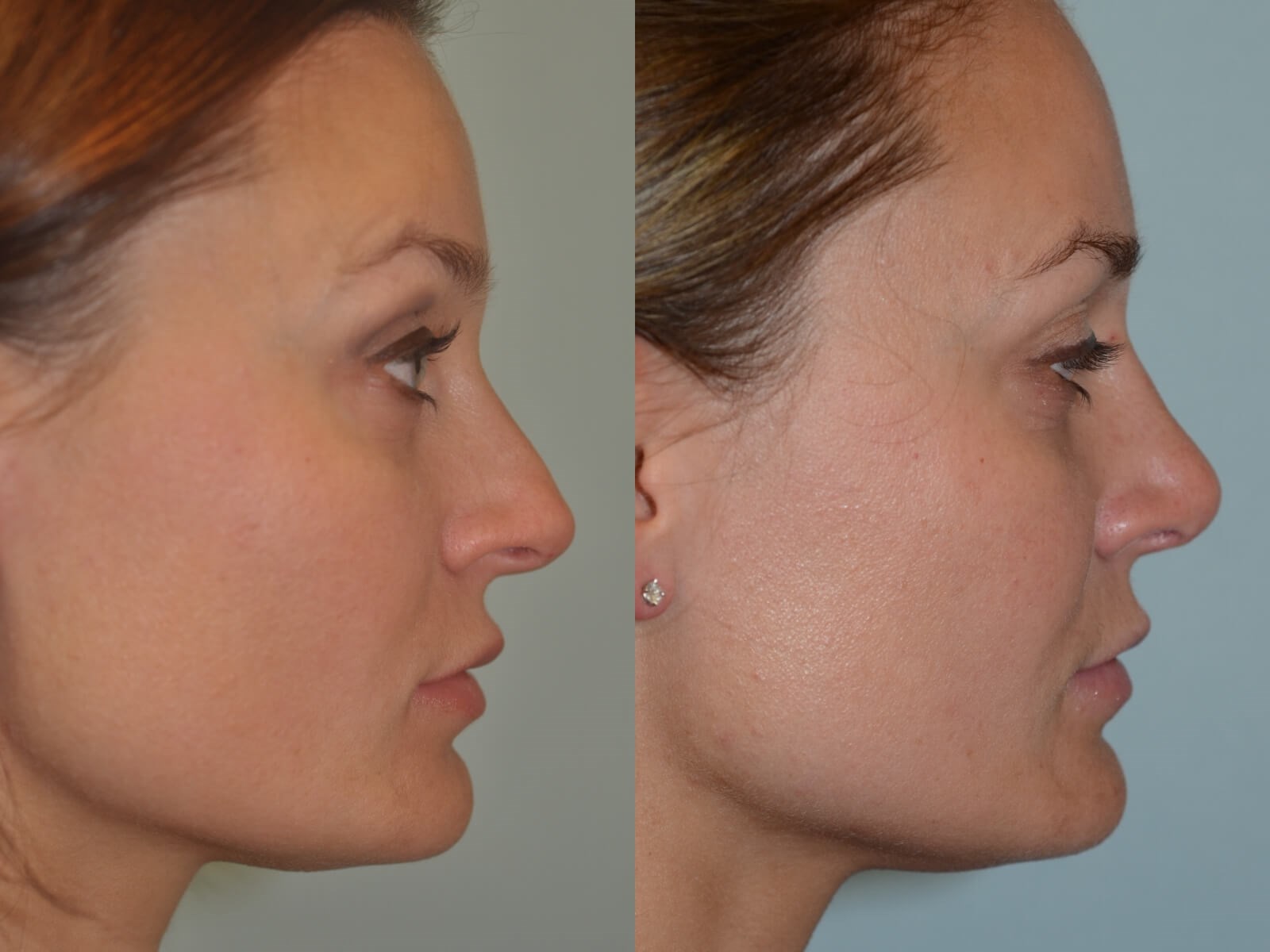 Rhinoplasty Before and After