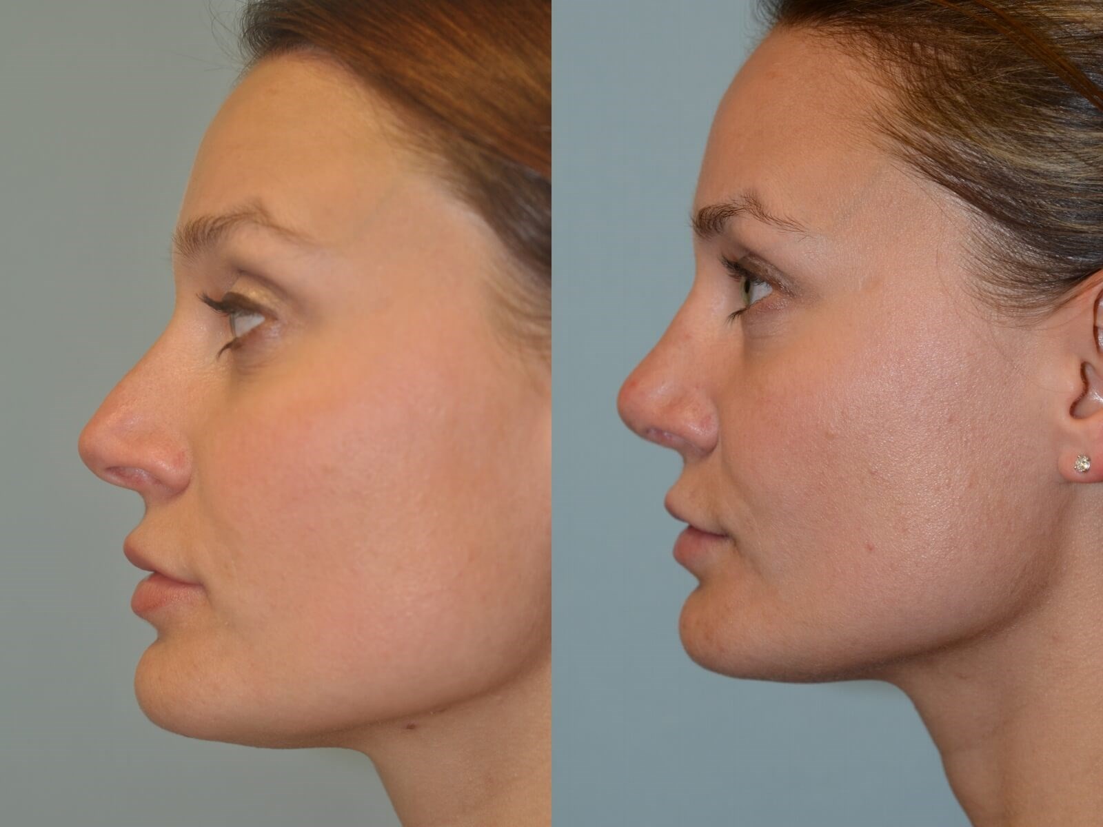 Rhinoplasty Before and After