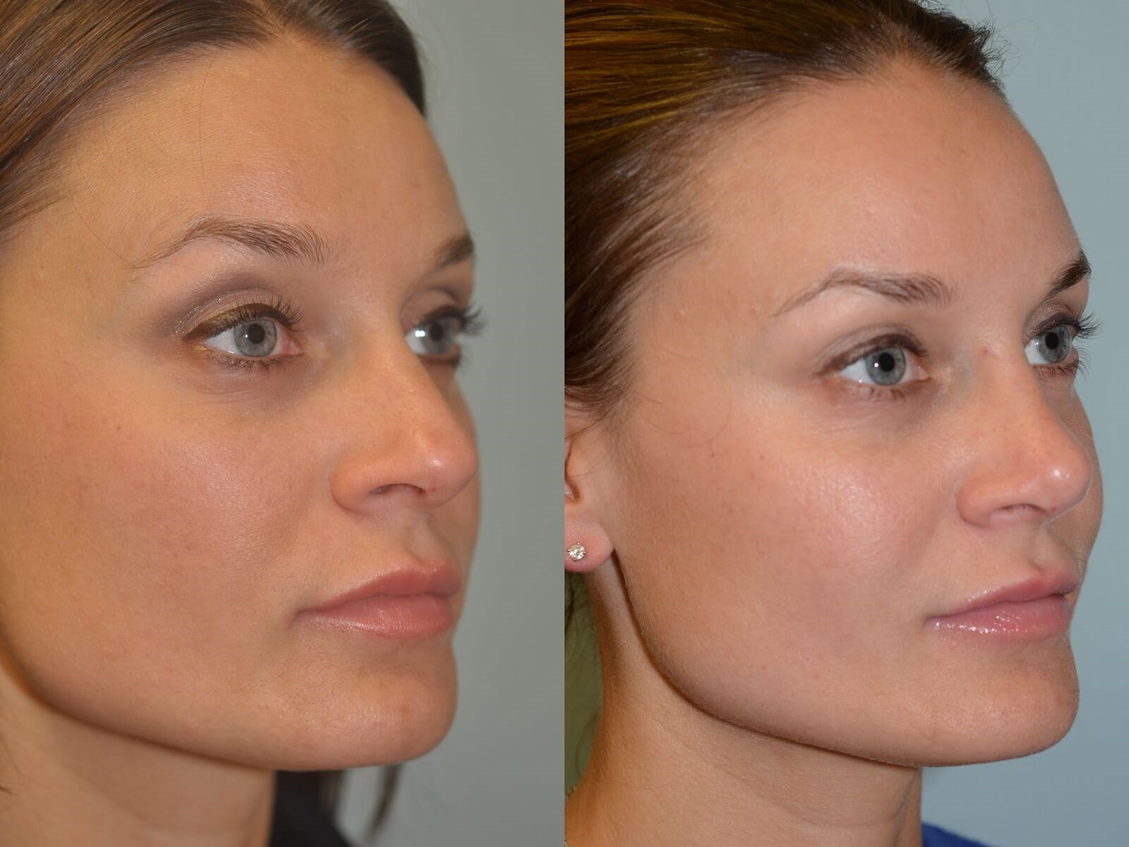 Rhinoplasty Before and After
