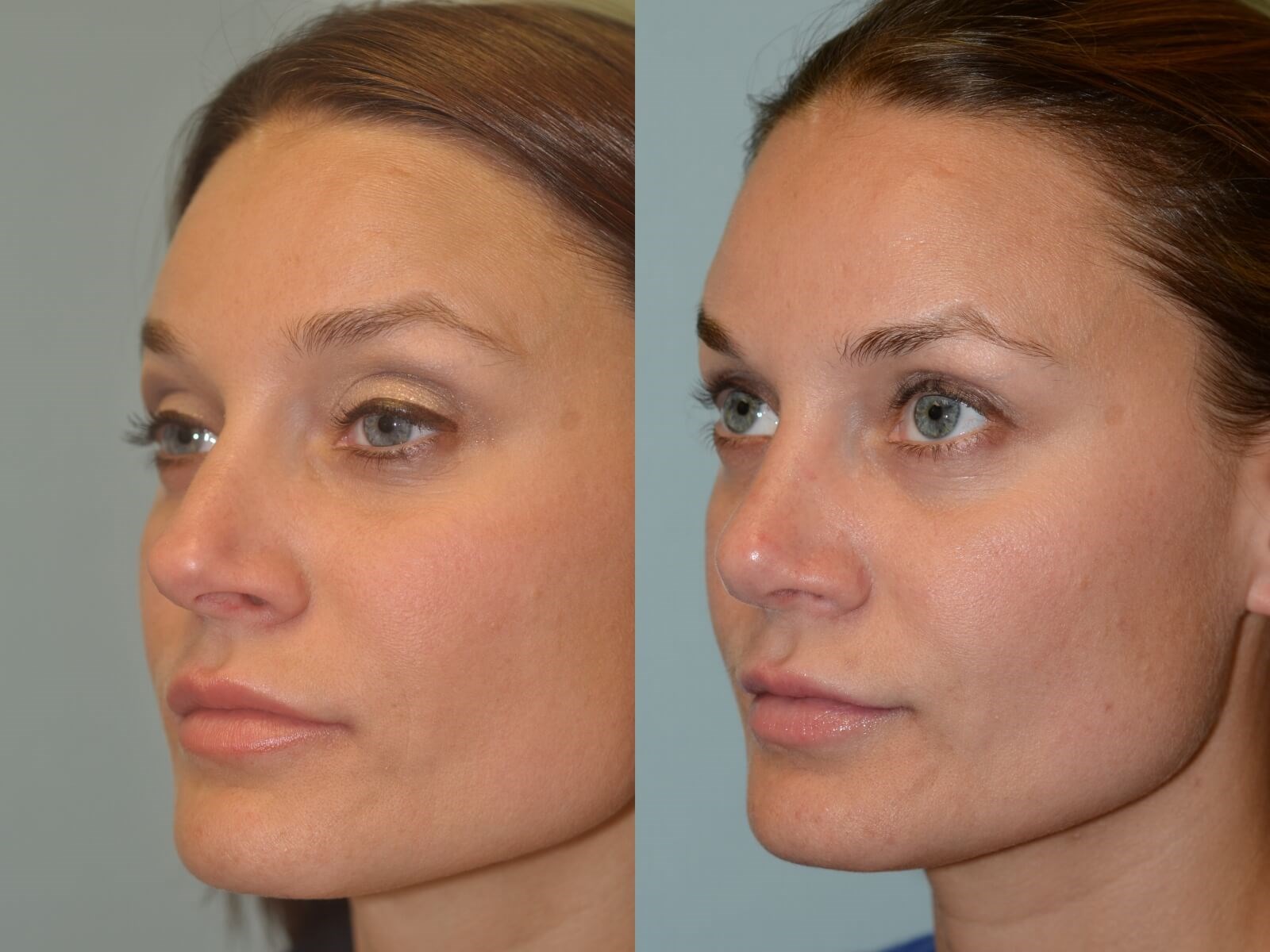 Rhinoplasty Before and After