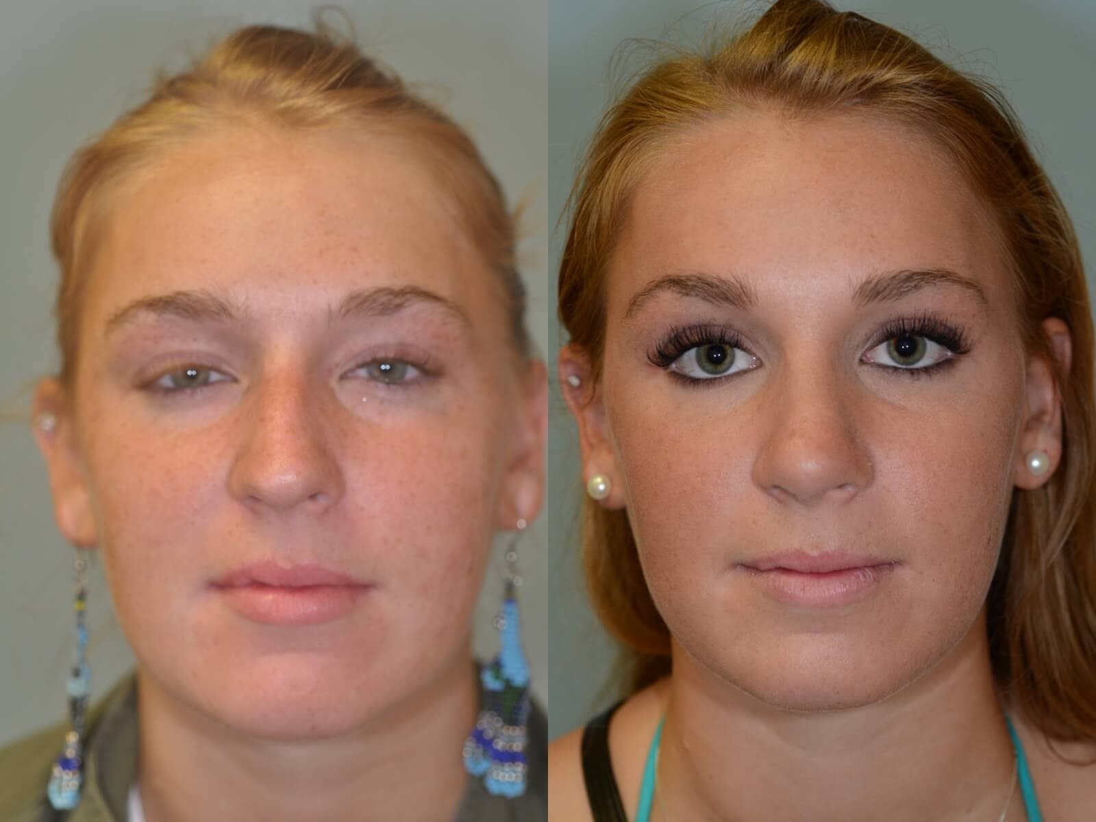 Rhinoplasty Before and After