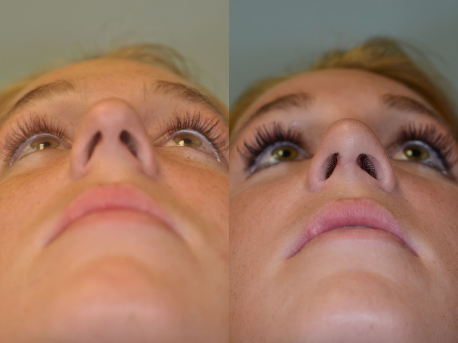 Rhinoplasty Before and After