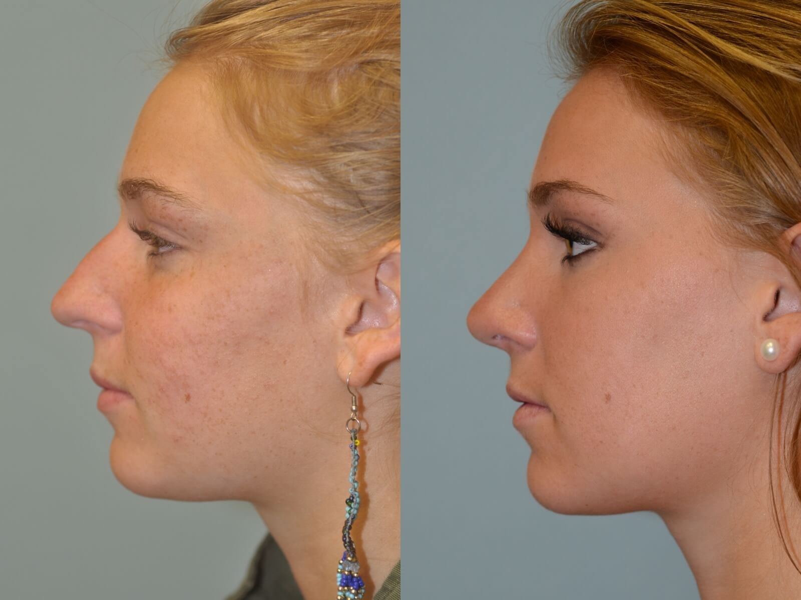 Rhinoplasty After