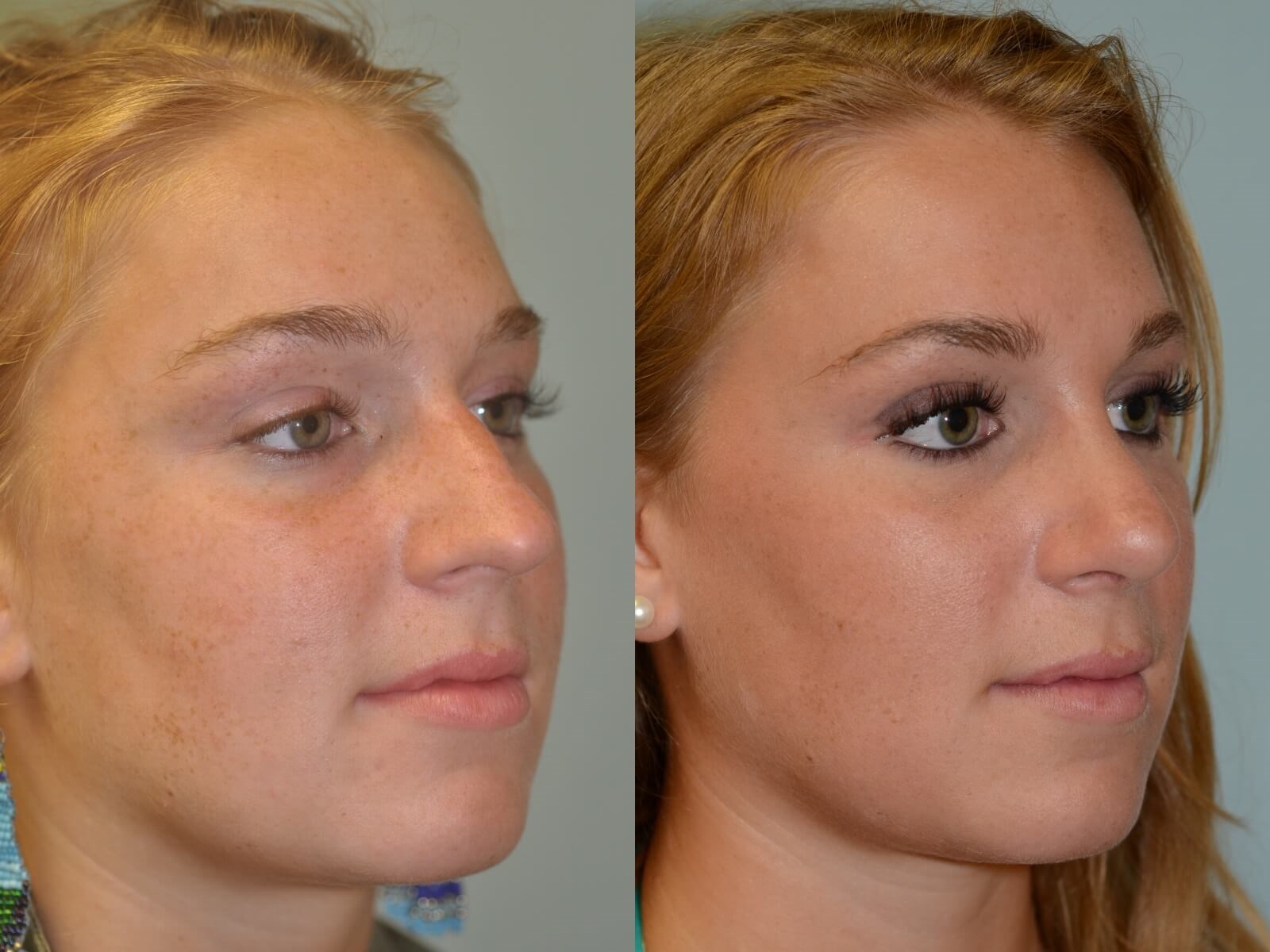 Rhinoplasty Before