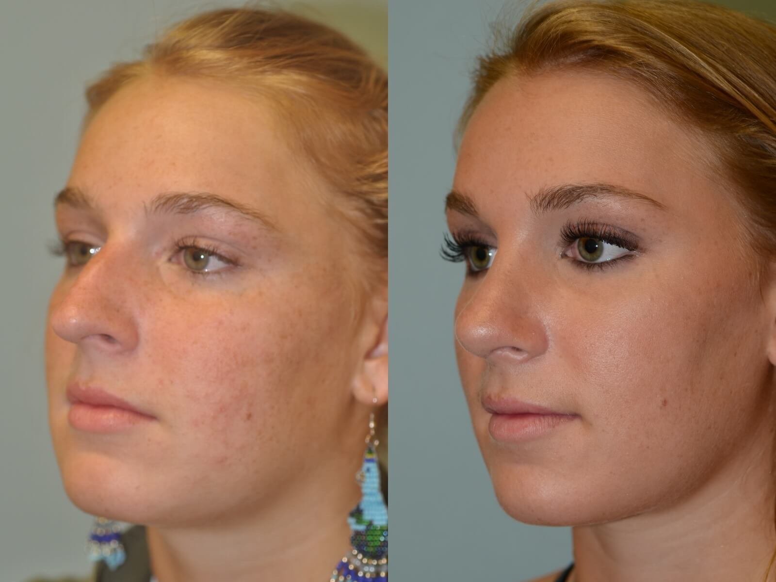 Rhinoplasty After