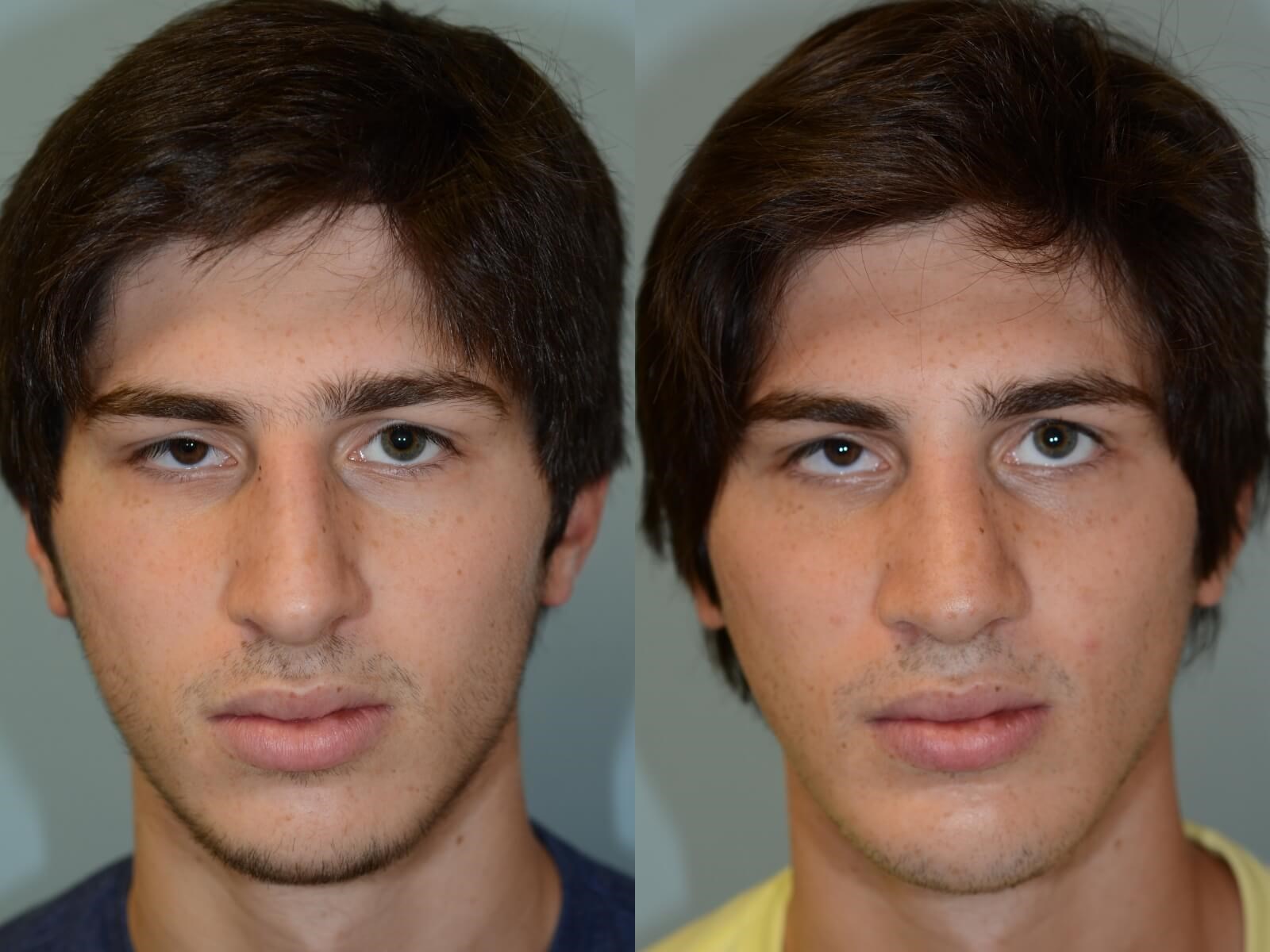 Rhinoplasty and Chin Implant Before and After