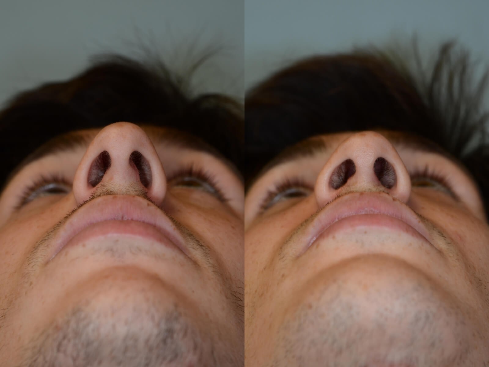 Rhinoplasty and Chin Implant Before and After