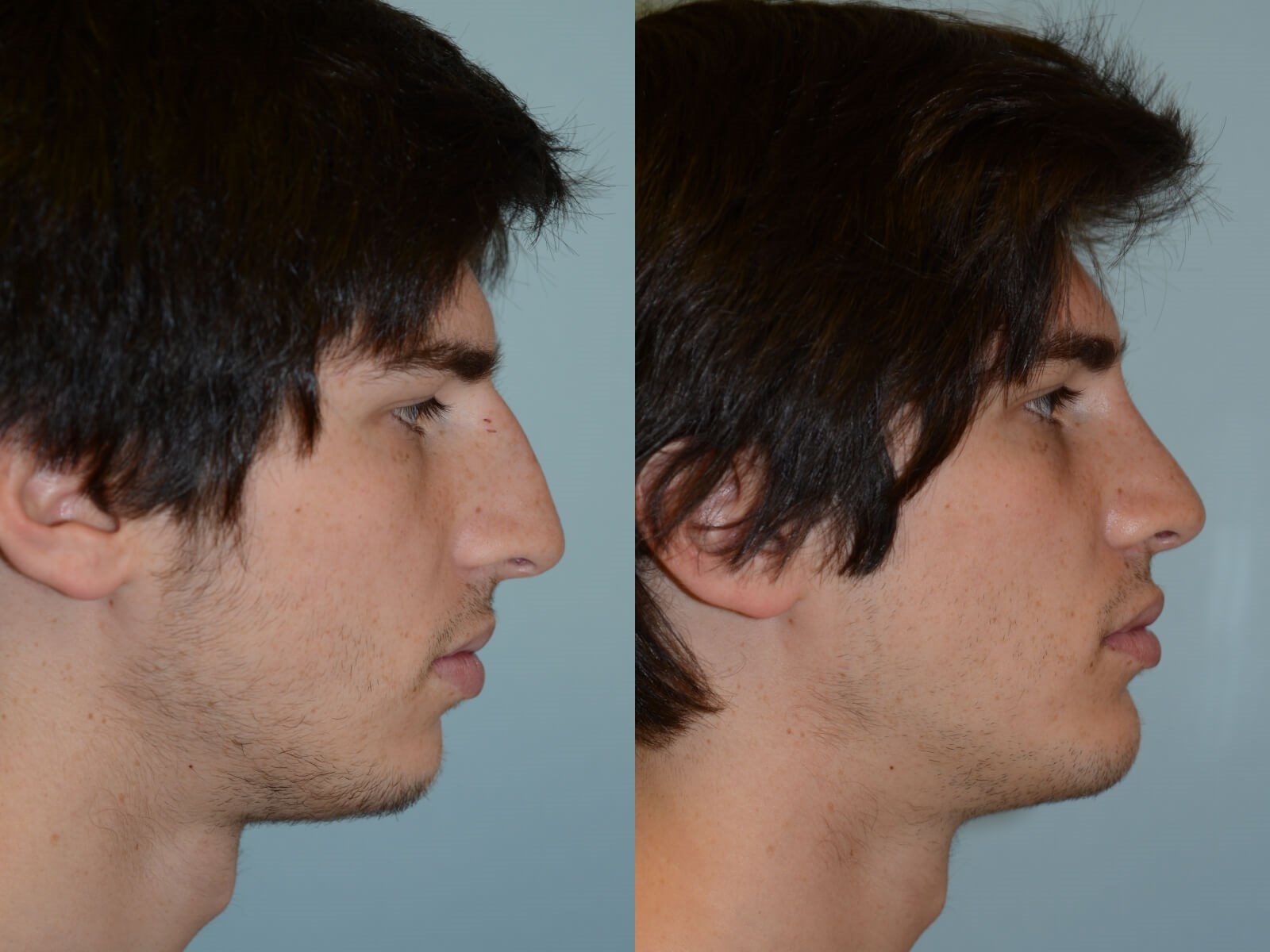 Rhinoplasty and Chin Implant Before and After