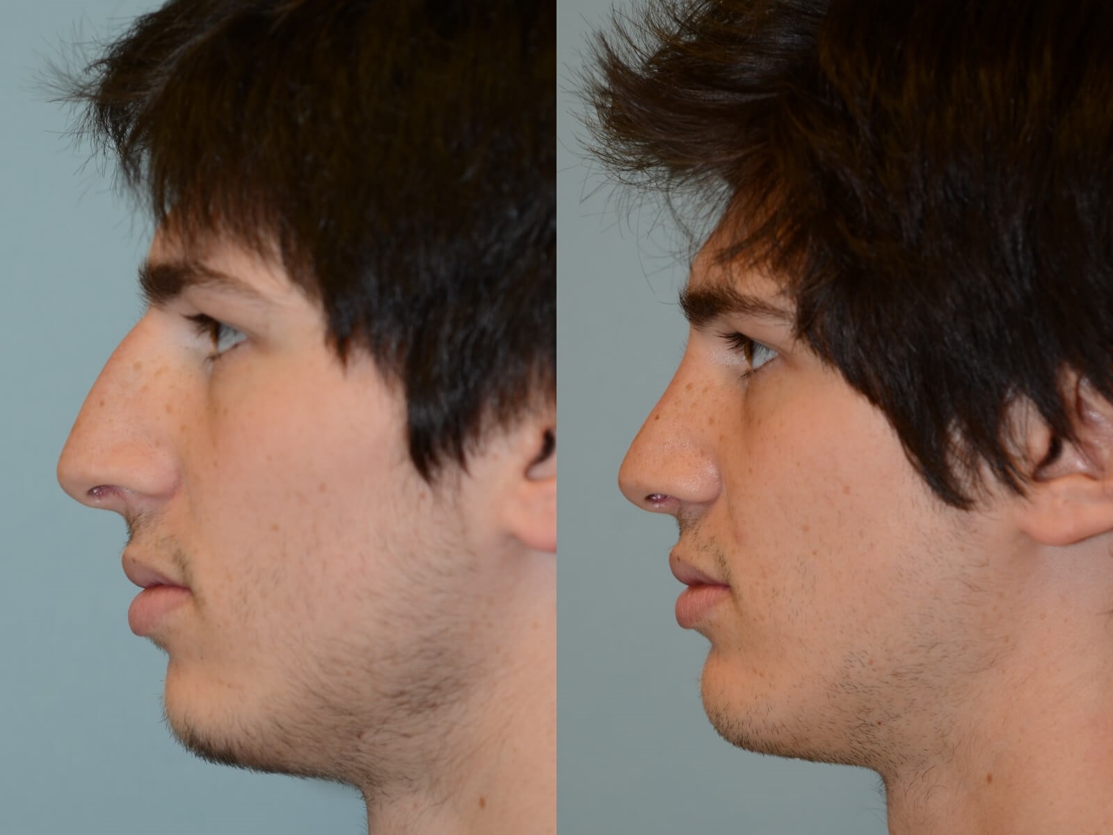 Rhinoplasty and Chin Implant Before and After