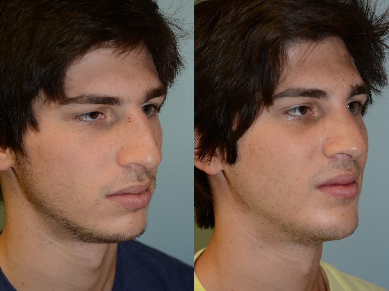 Rhinoplasty and Chin Implant Before and After