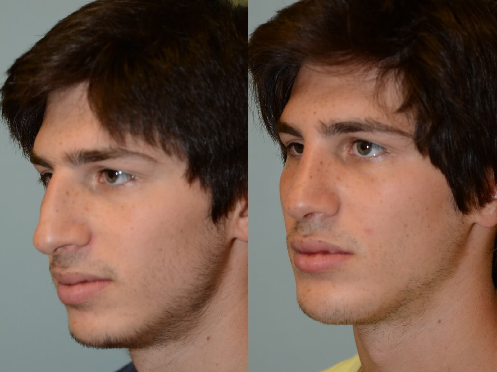 Rhinoplasty and Chin Implant Before and After