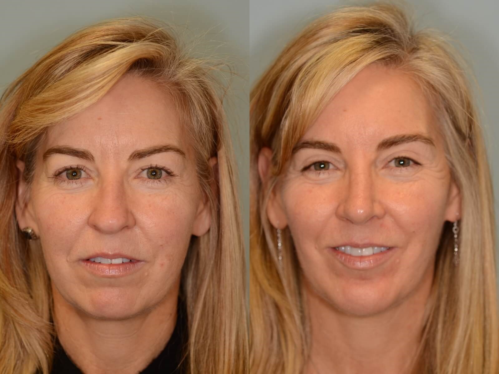 Rhinoplasty and Chin Implant Before and After