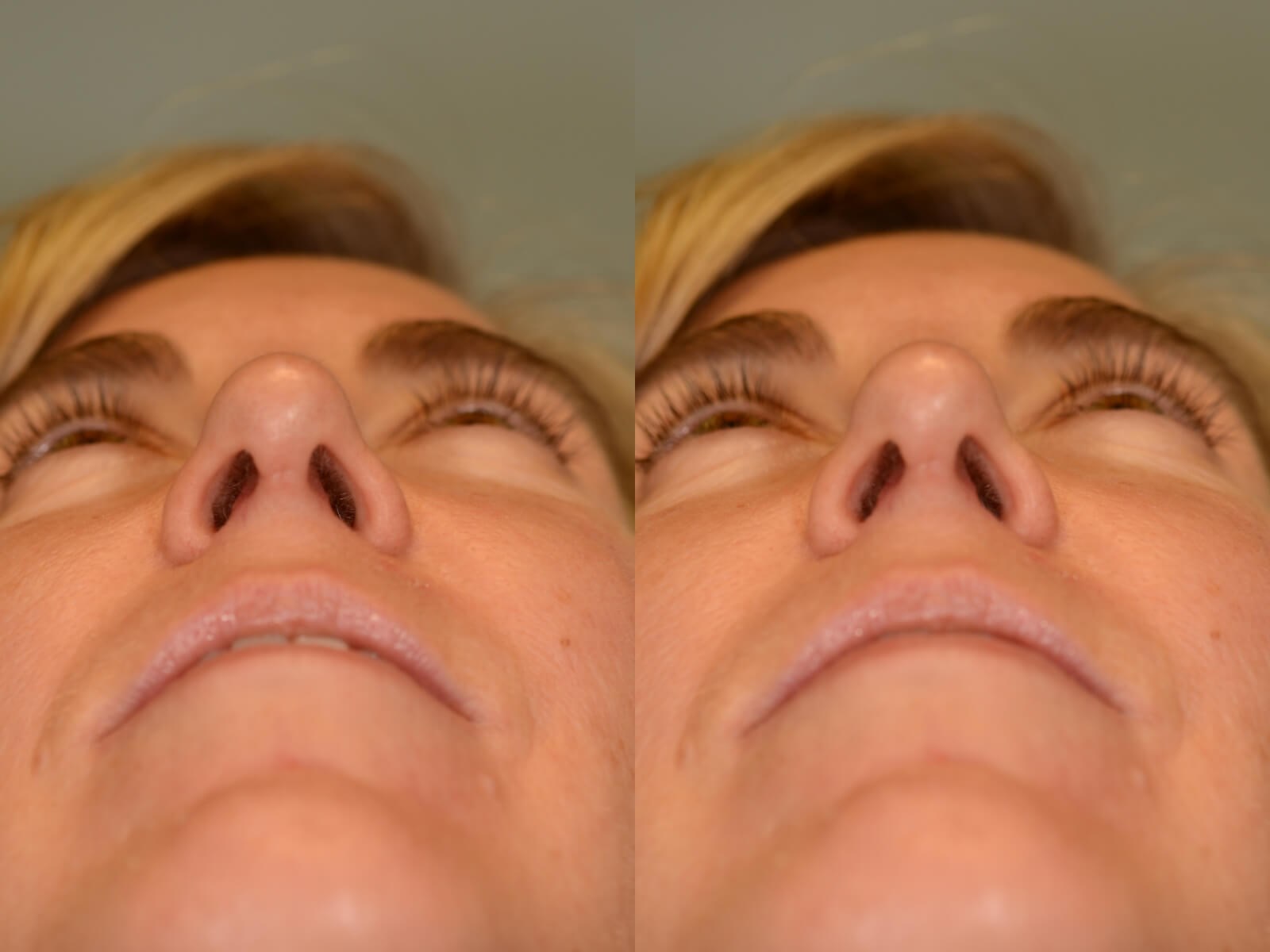 Rhinoplasty and Chin Implant Before and After