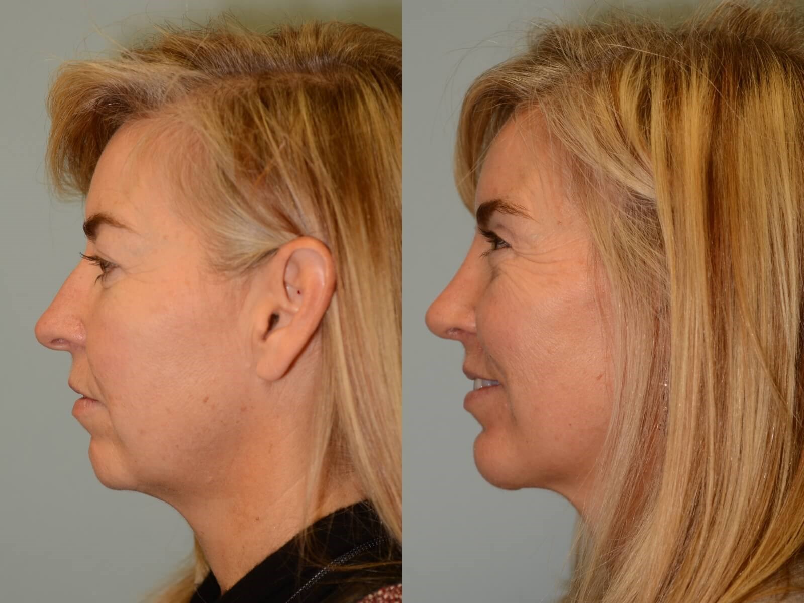 Rhinoplasty and Chin Implant Before and After