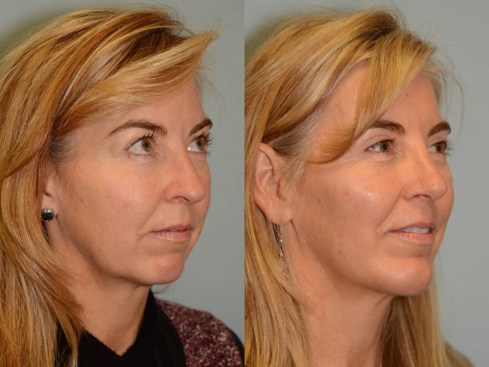 Rhinoplasty and Chin Implant Before and After