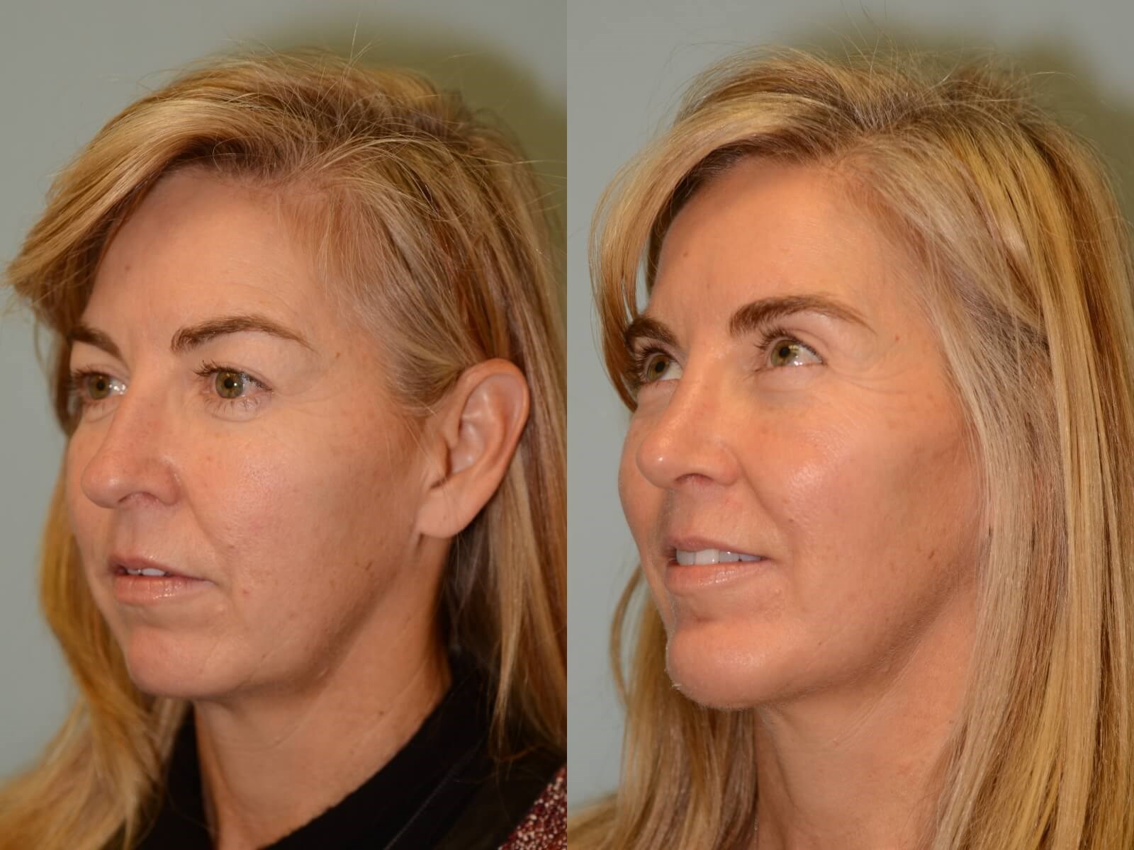 Rhinoplasty and Chin Implant Before and After