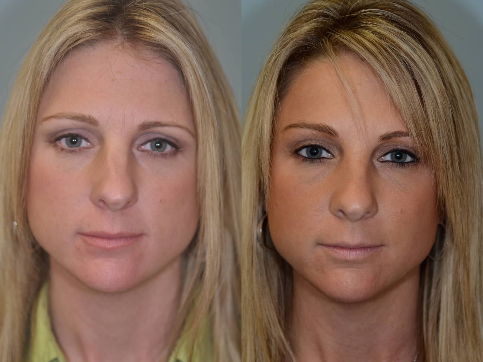 Rhinoplasty Before and After