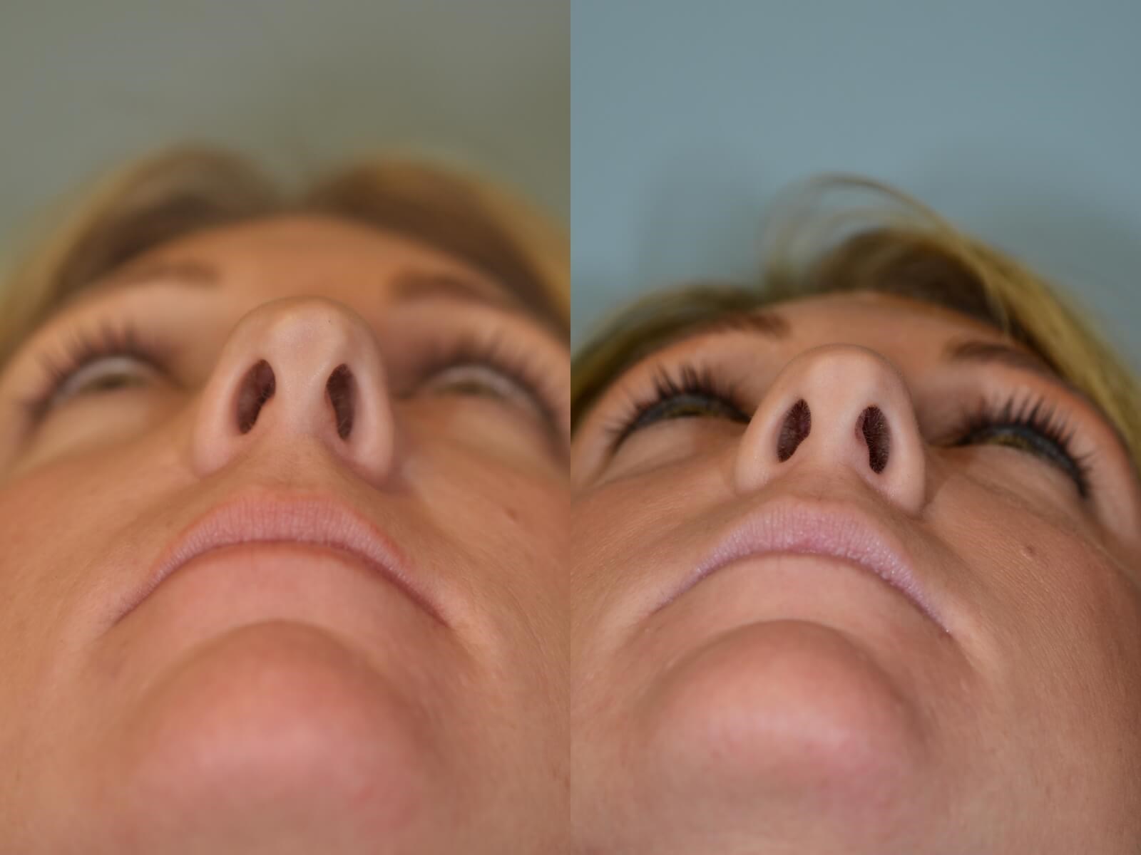 Rhinoplasty Before and After