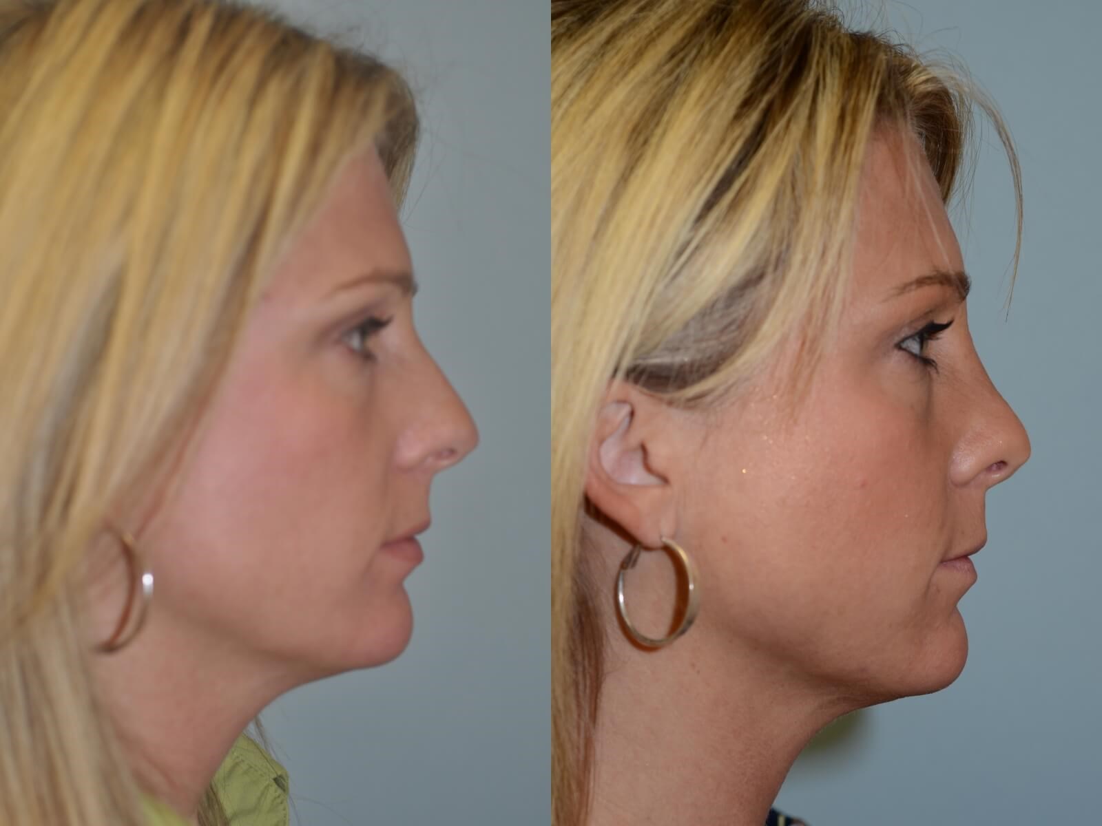Rhinoplasty Before and After