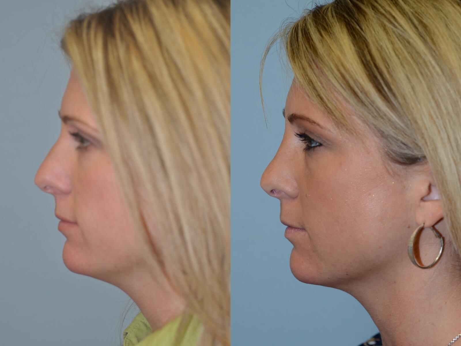 Rhinoplasty Before and After