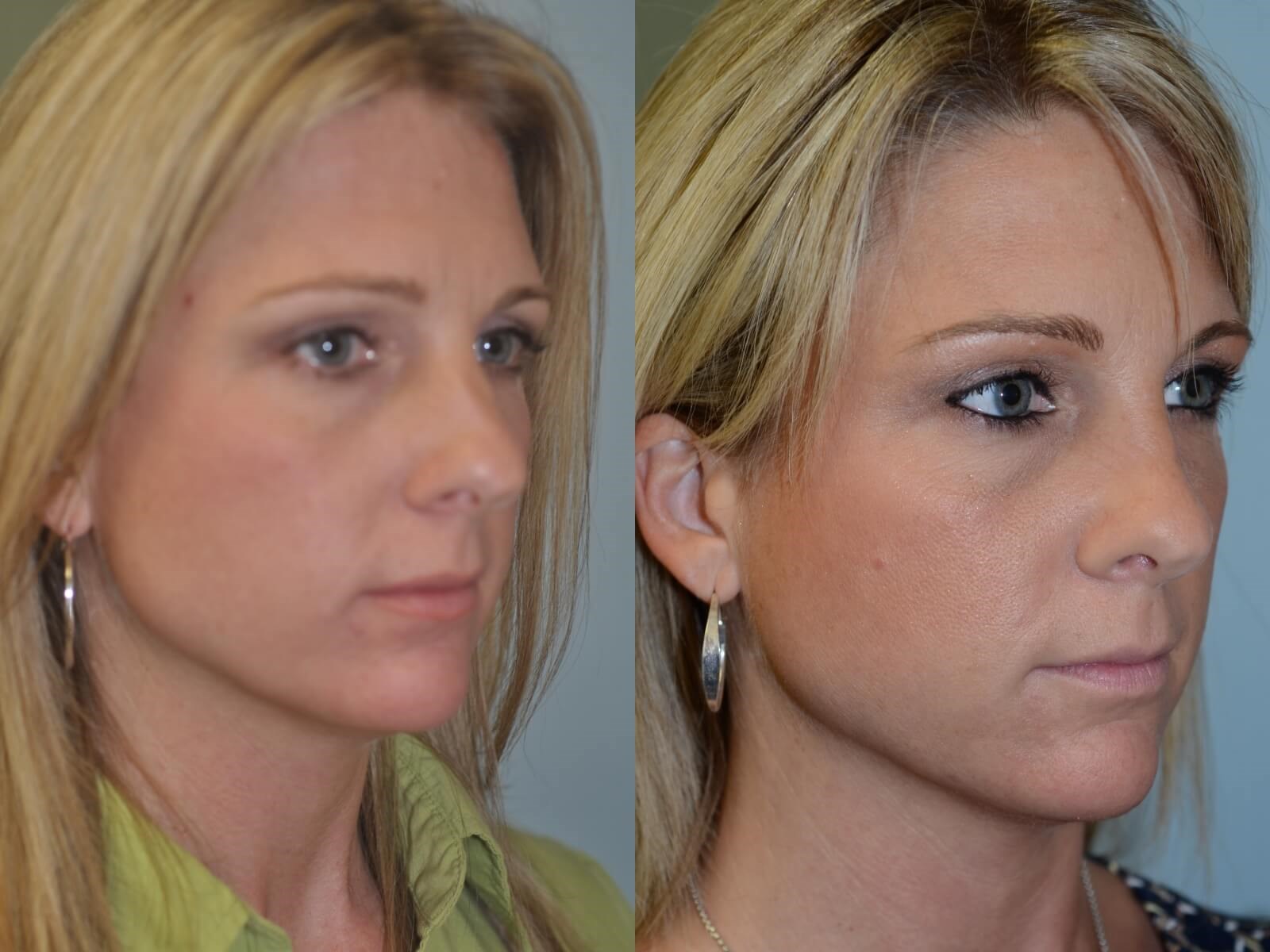 Rhinoplasty Before and After