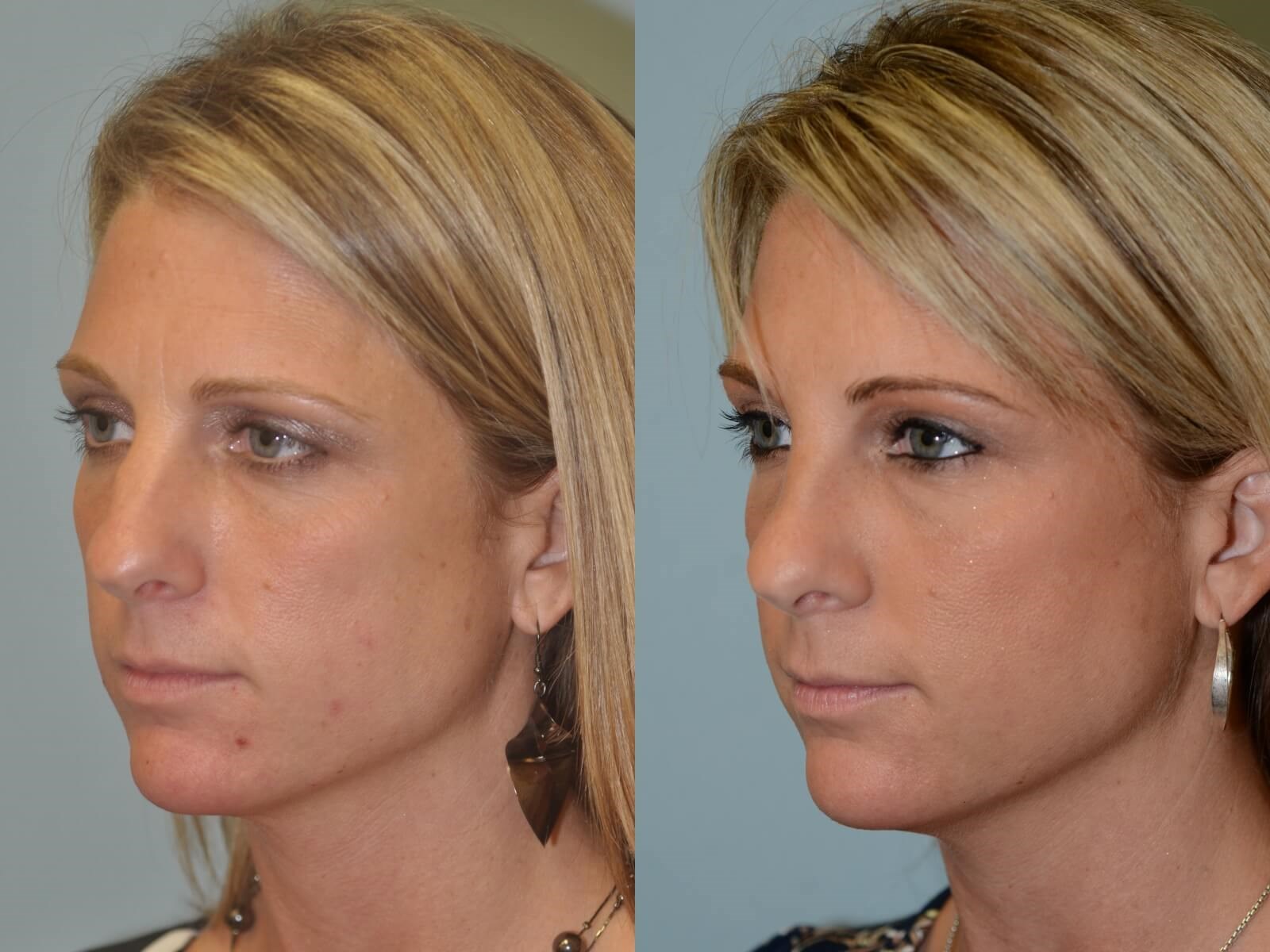 Rhinoplasty Before and After