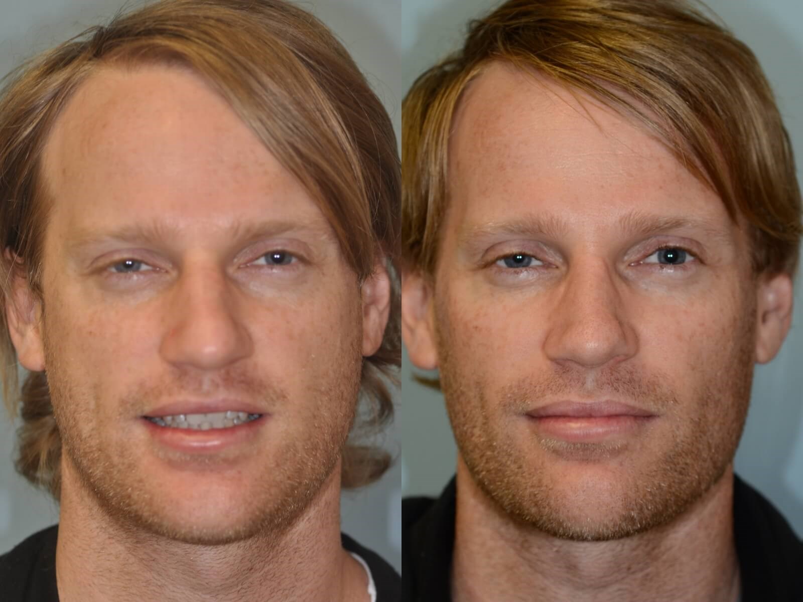Rhinoplasty Before and After