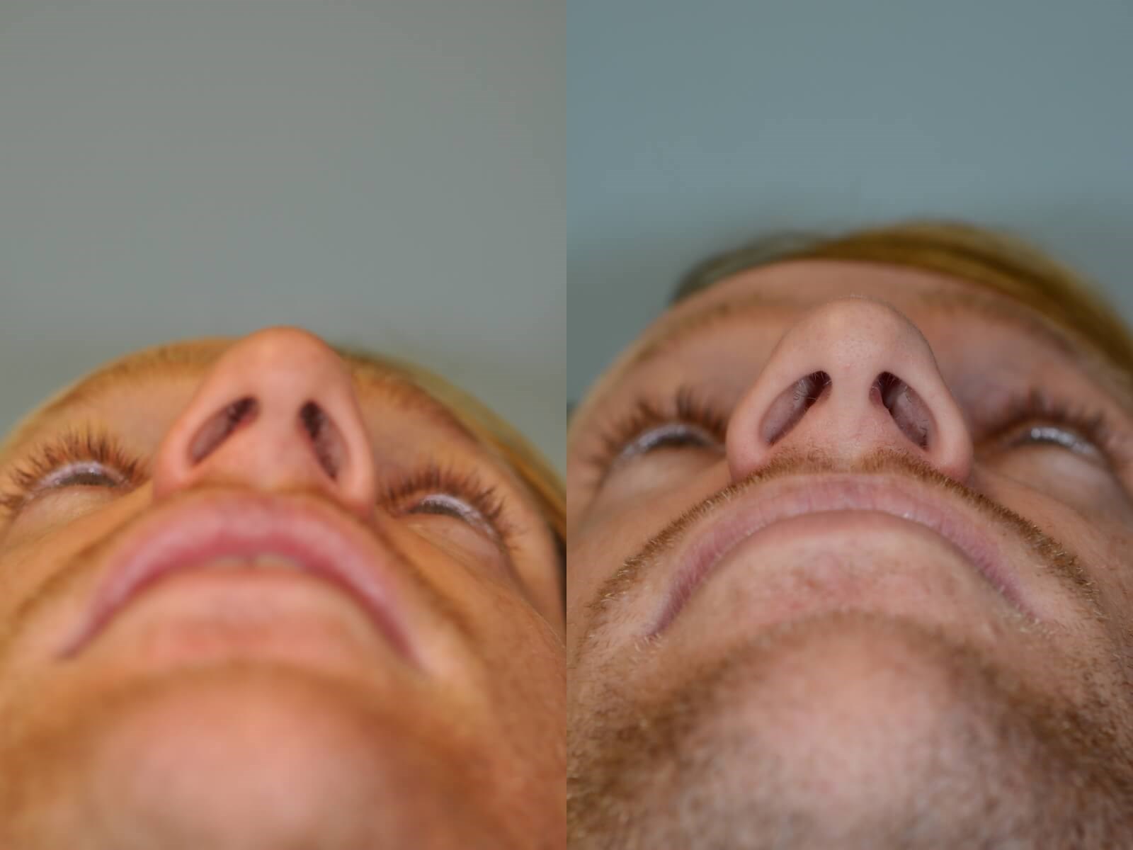 Rhinoplasty Before and After