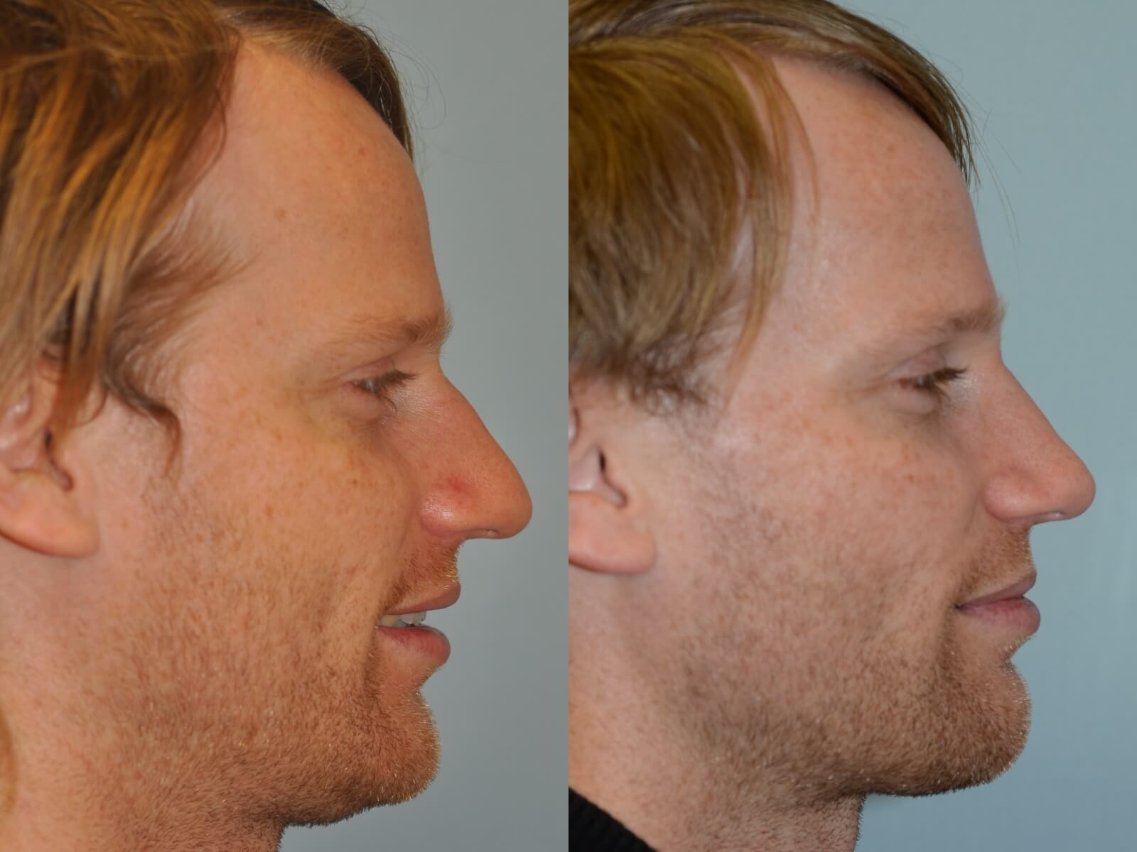 Rhinoplasty Before and After