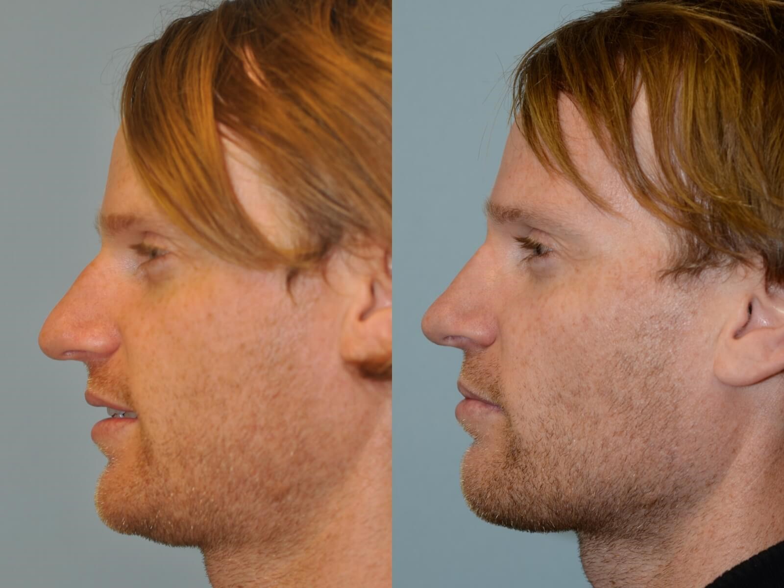 Rhinoplasty Before and After
