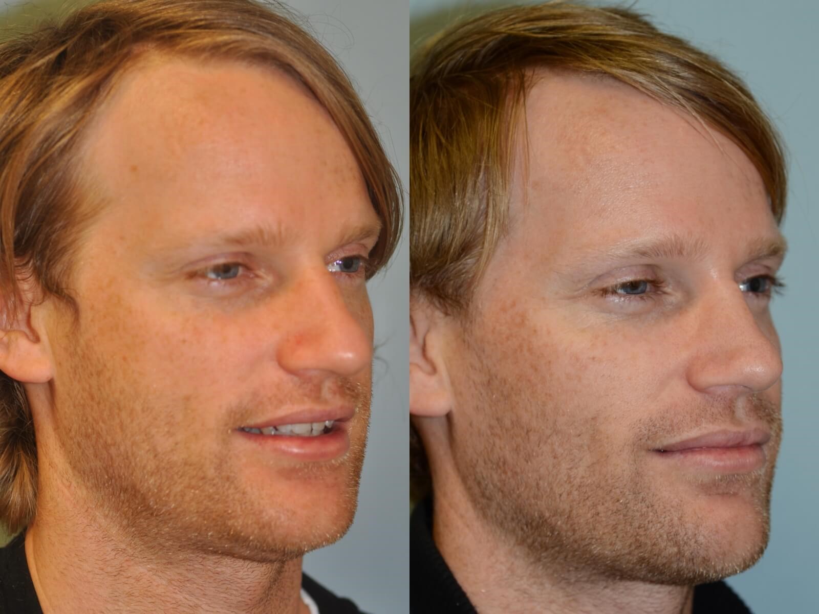 Rhinoplasty Before and After