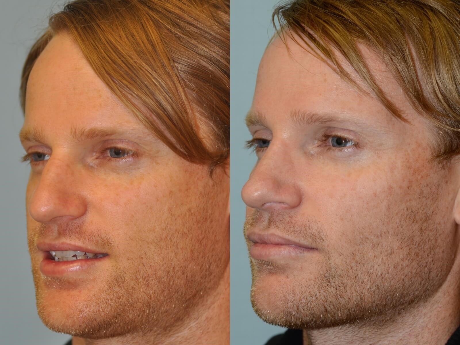Rhinoplasty Before and After