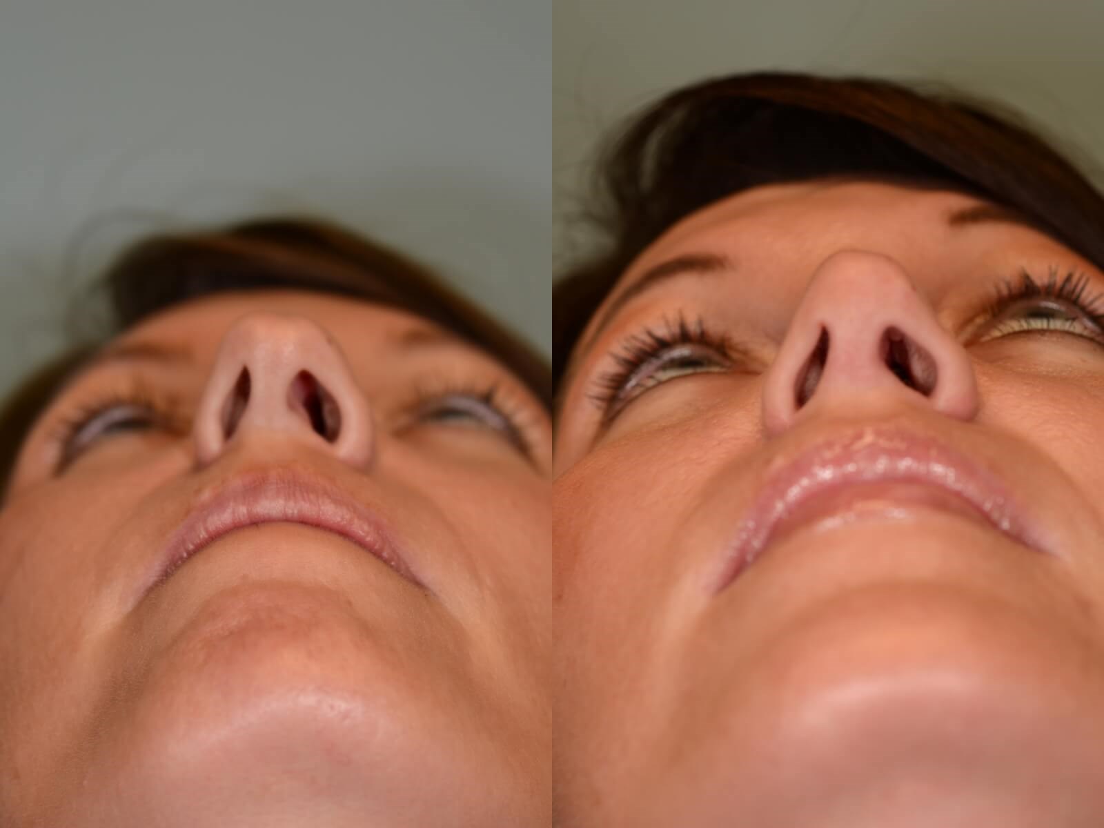 Rhinoplasty Before and After