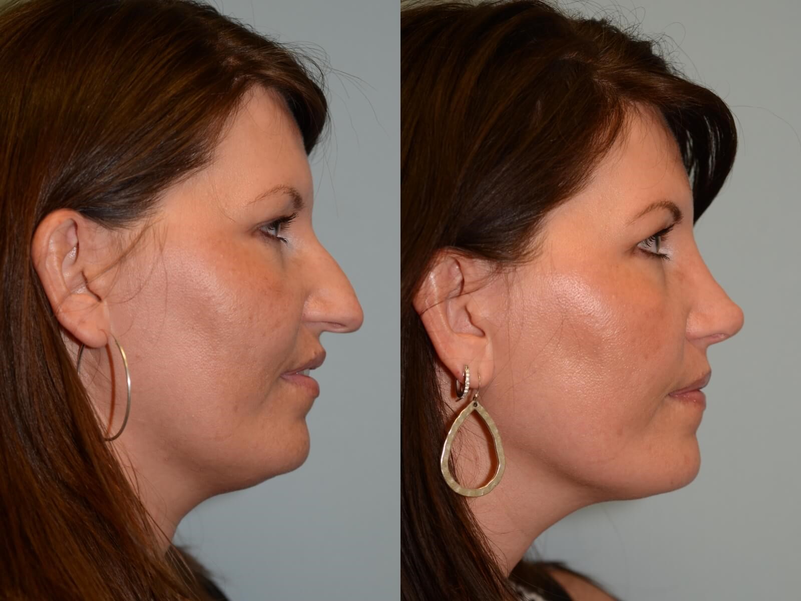 A more feminine nasal tip Before and After