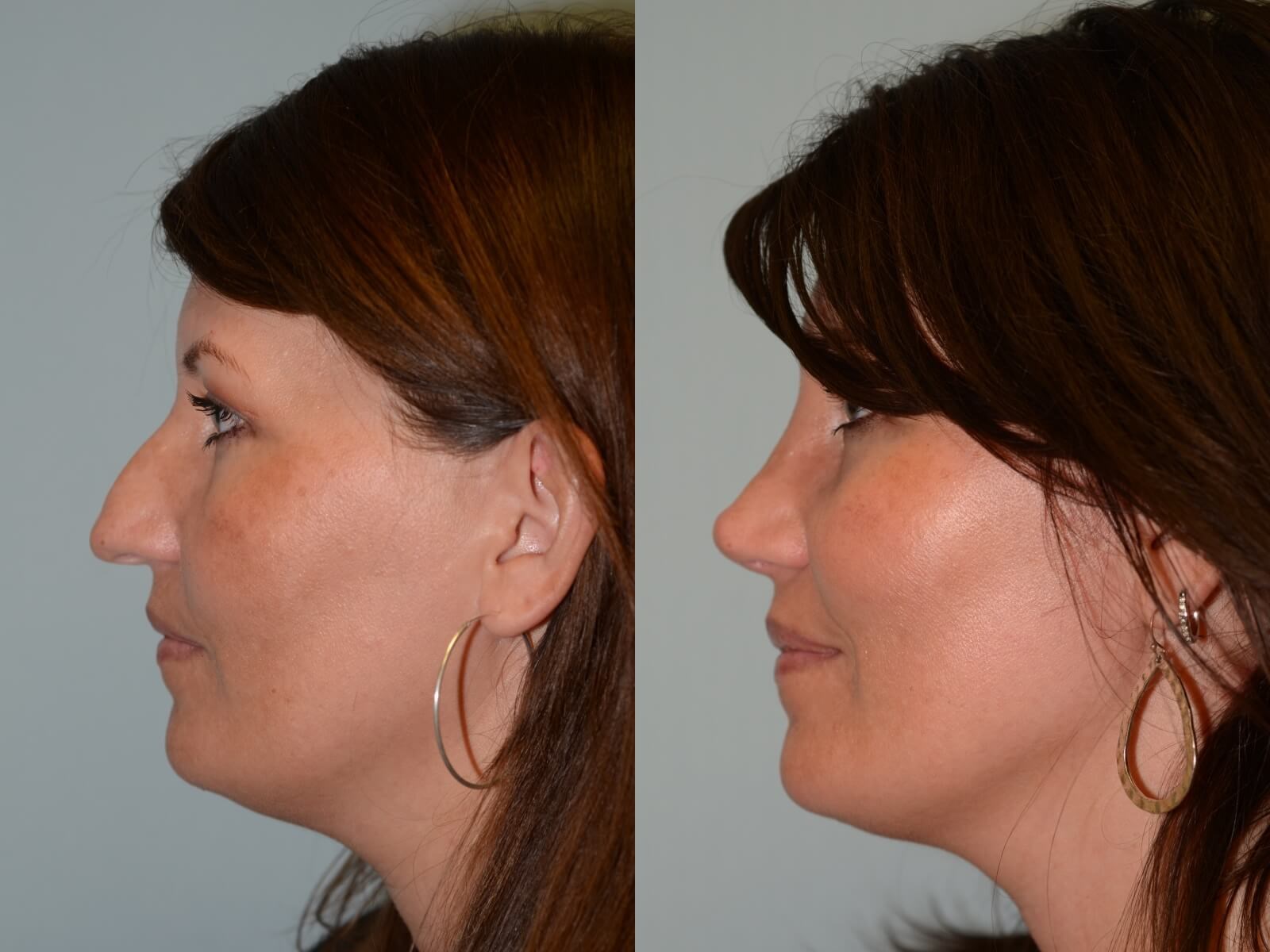 Revision Rhinoplasty In Houston