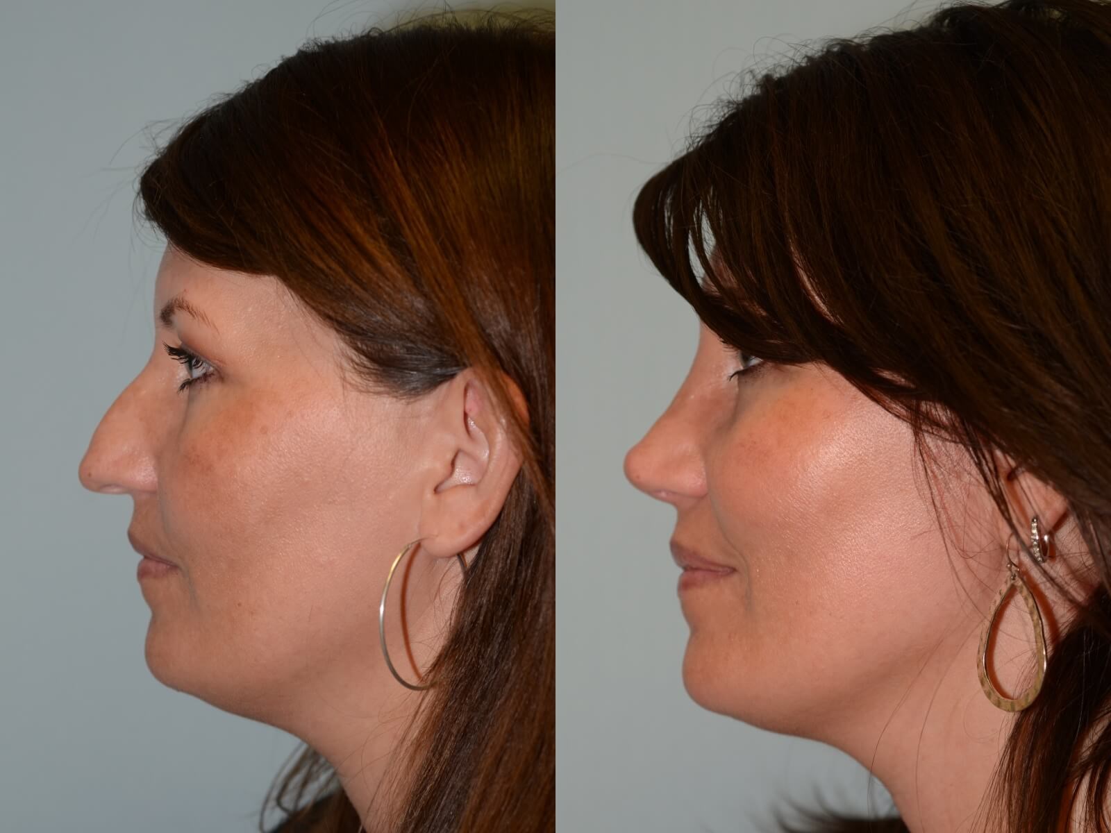 A more feminine nasal tip Before and After