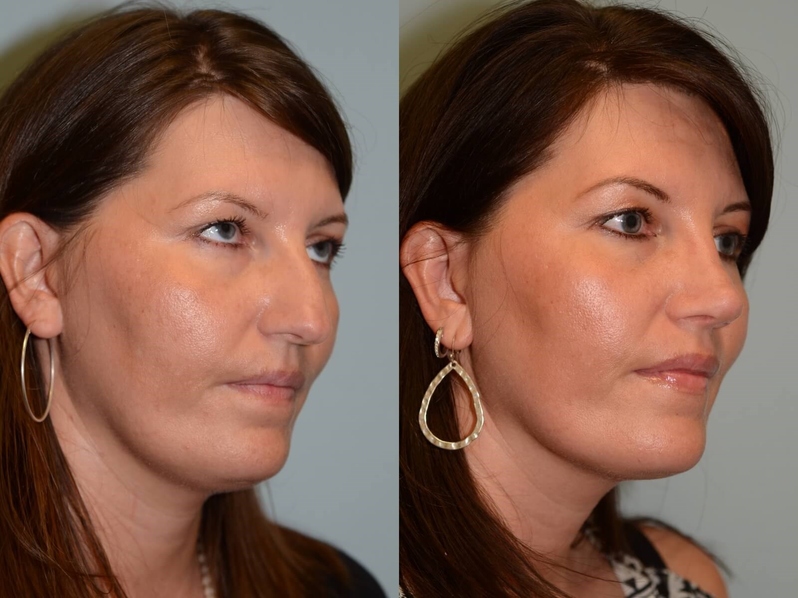 Softer nasal slope Before and After