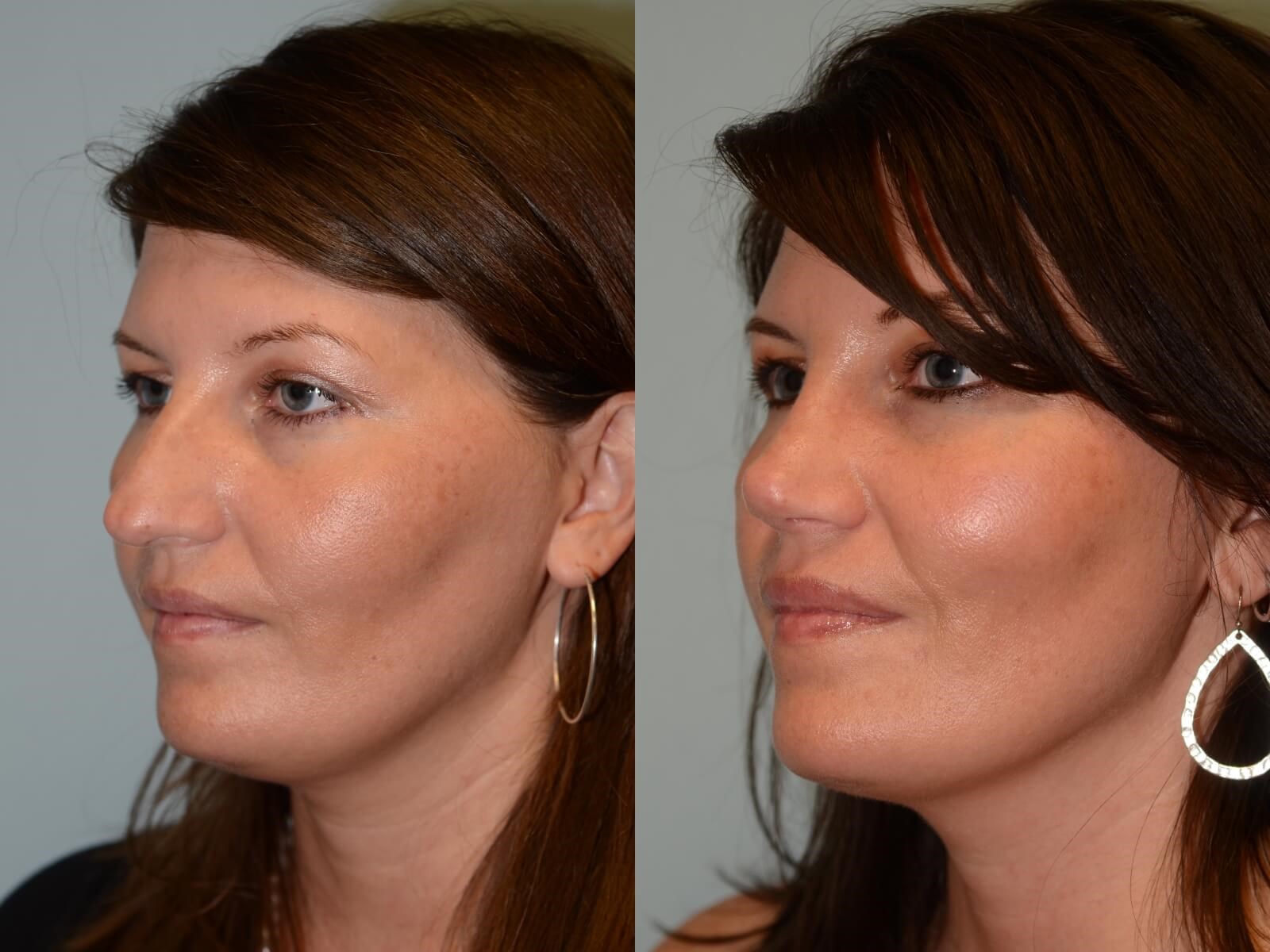 Softer nasal slope Before and After