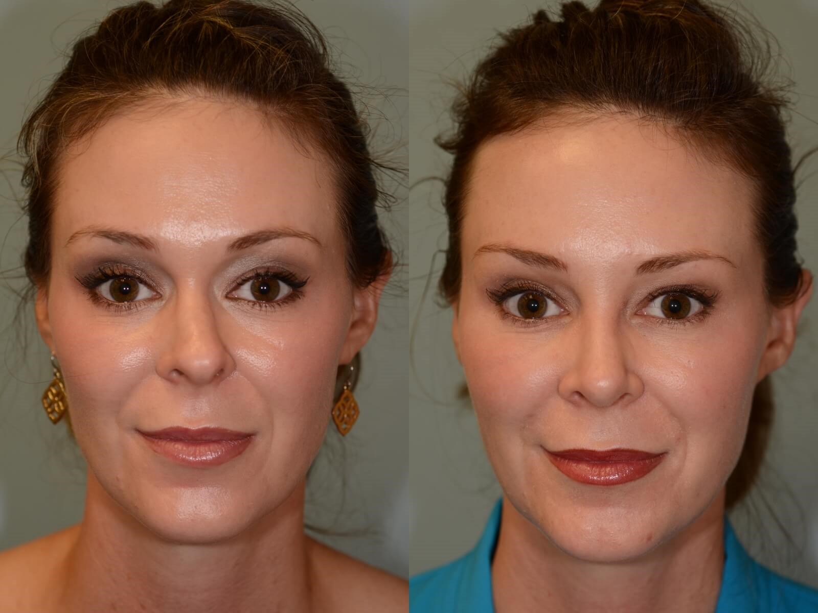 Houston, TX Rhinoplasty Before and After