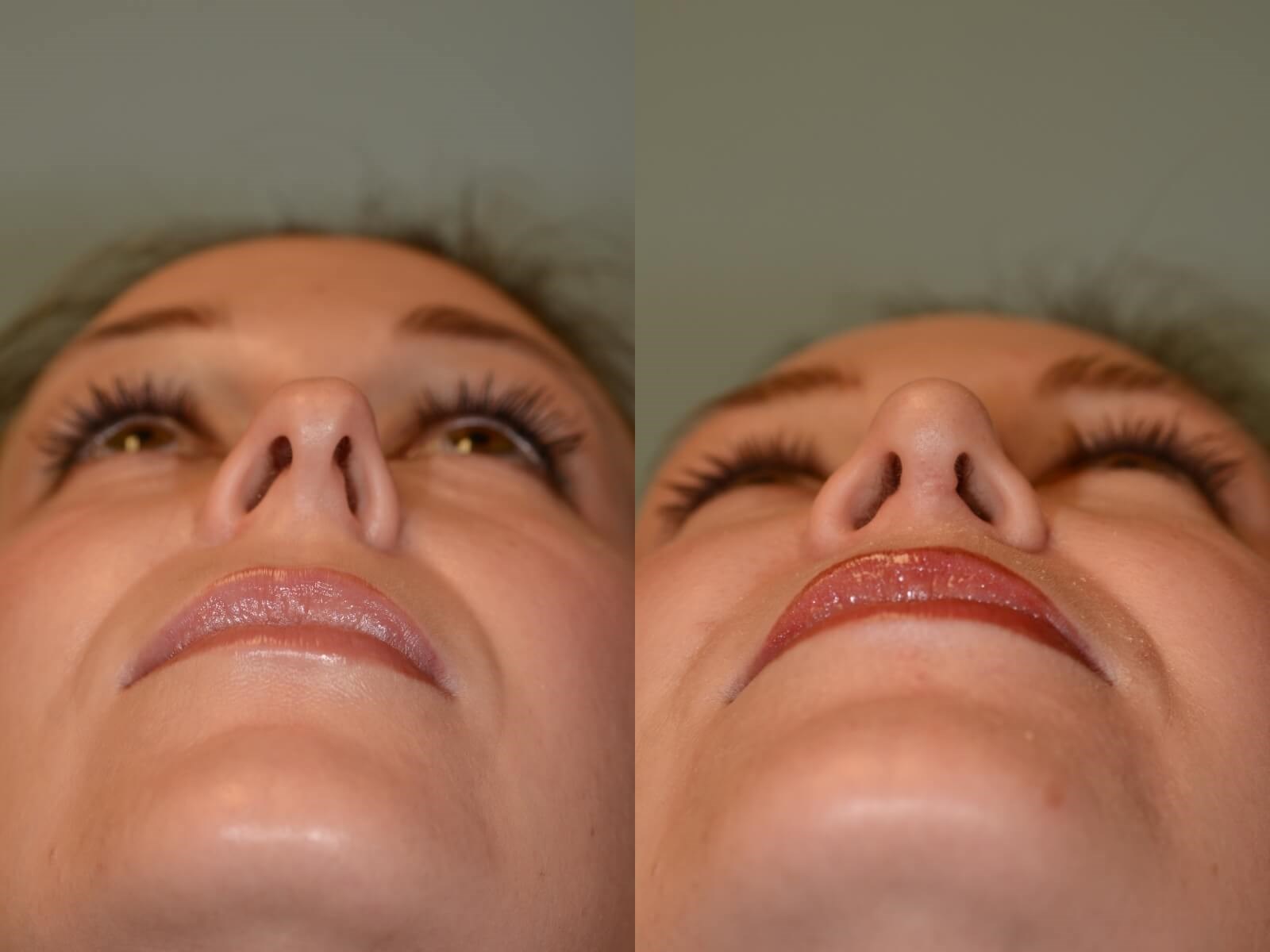 Houston, TX Rhinoplasty Before and After