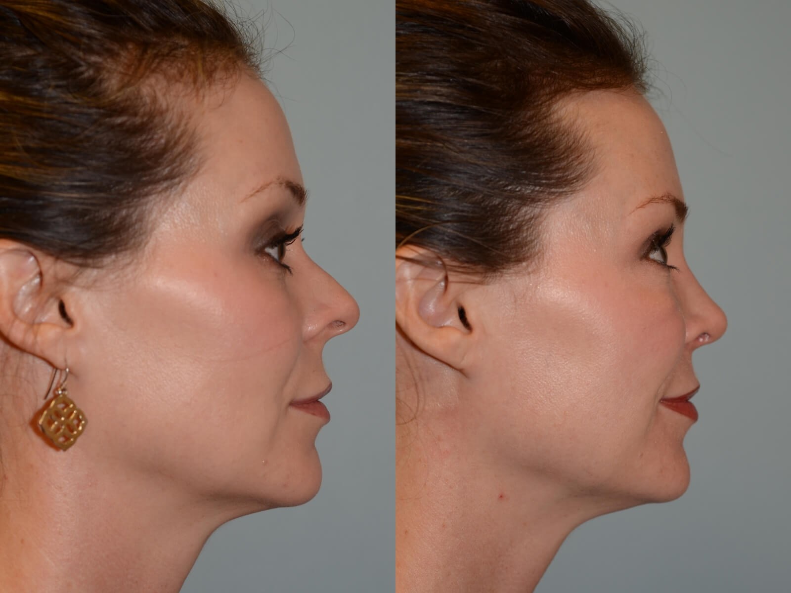 Rhinoplasty Before and After