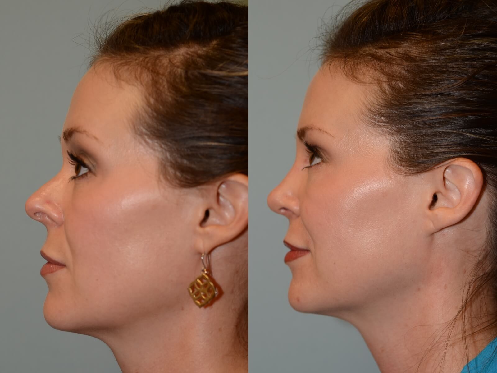 Rhinoplasty Before and After