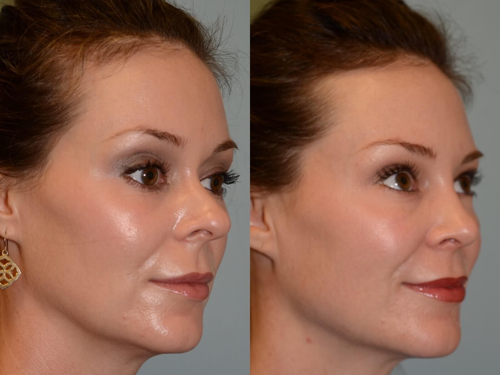 Rhinoplasty Before and After