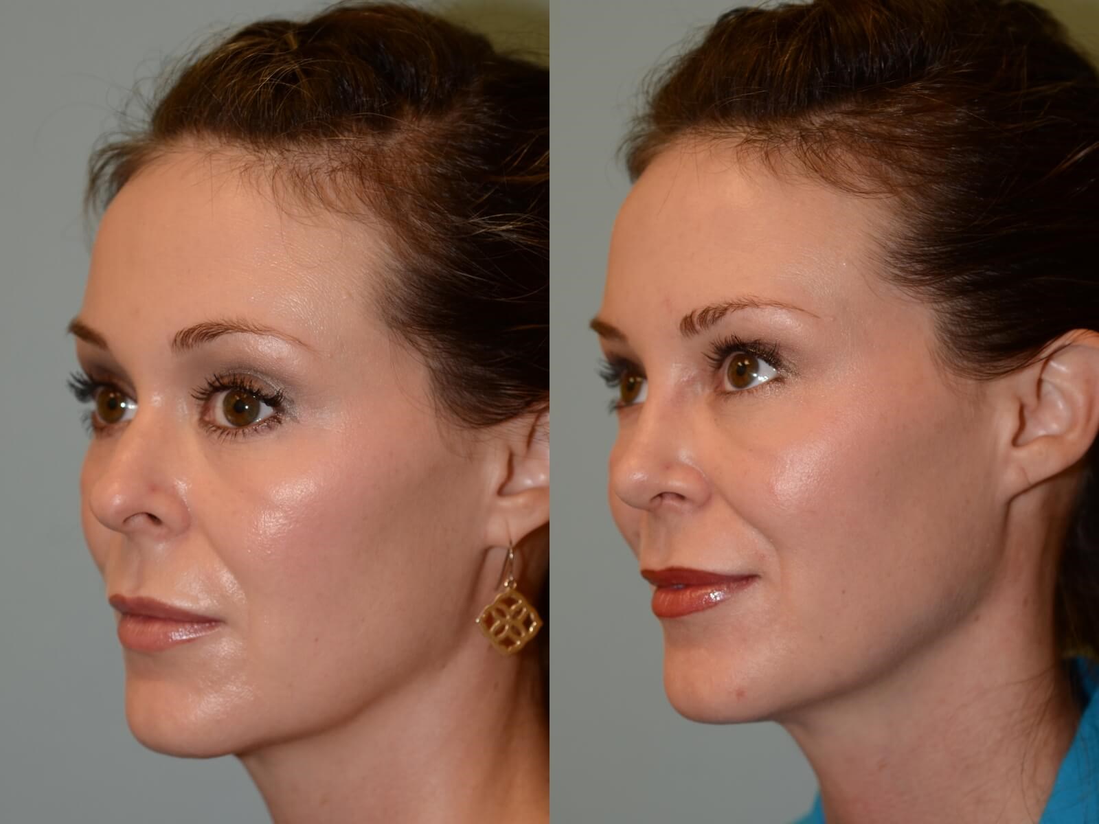Rhinoplasty Before and After
