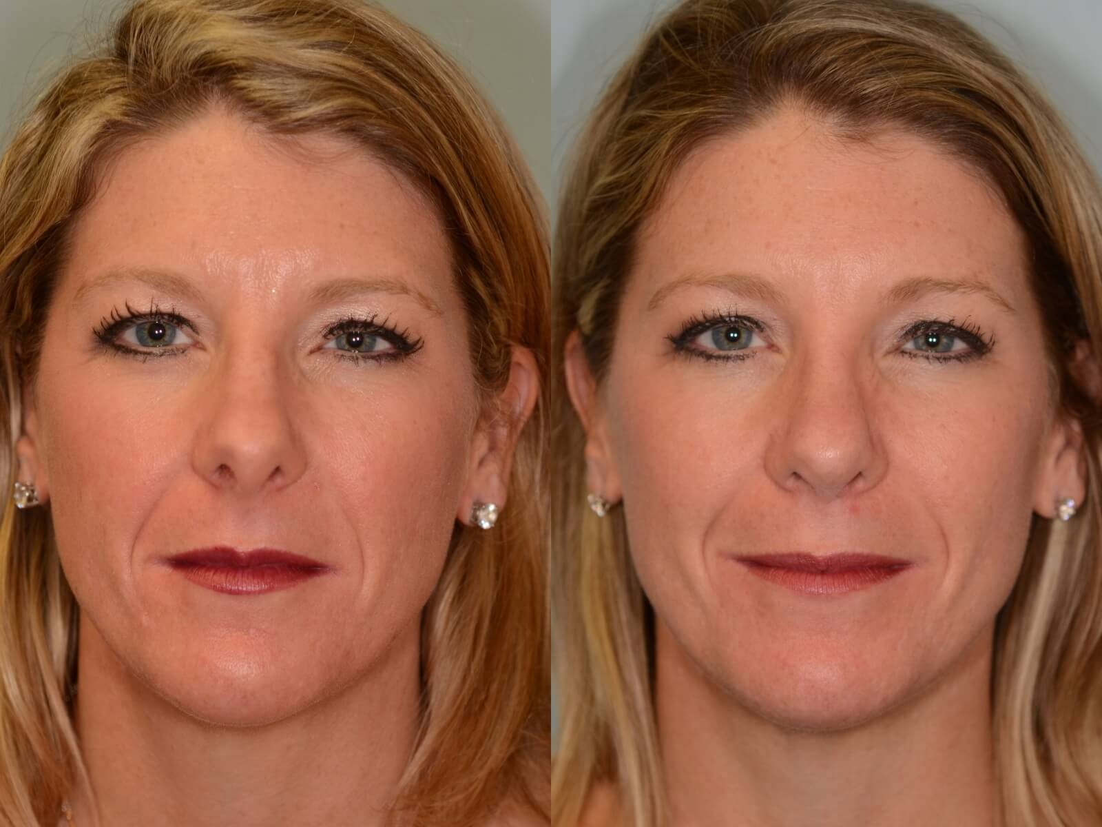 Rhinoplasty Before and After 6 months