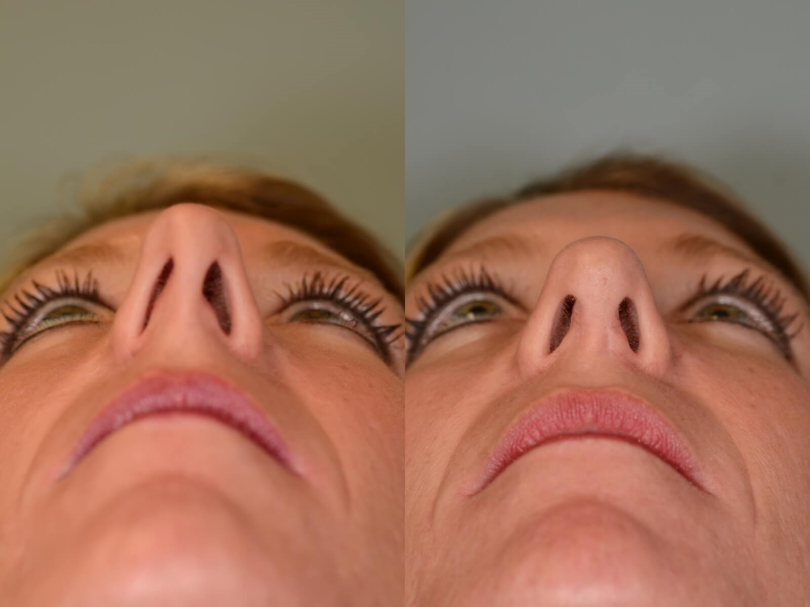Rhinoplasty Before and After 6 months