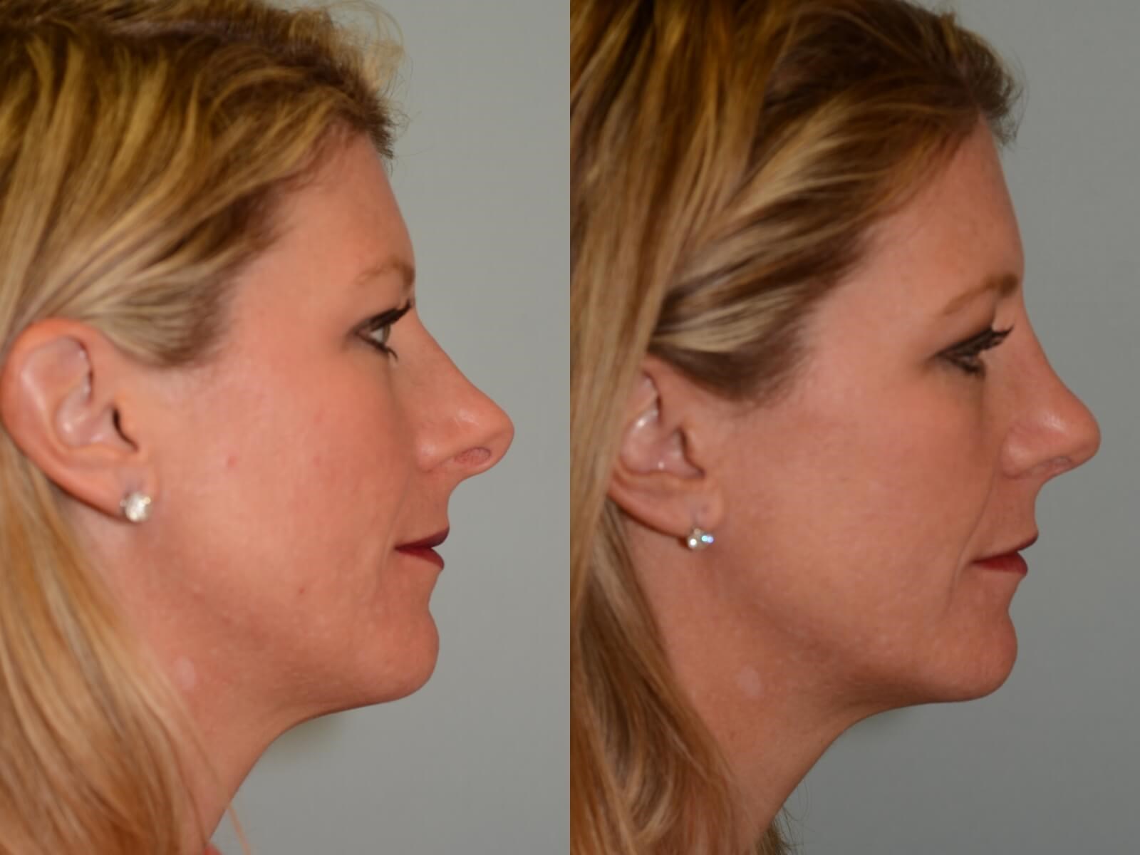 Rhinoplasty Before and After 6 months