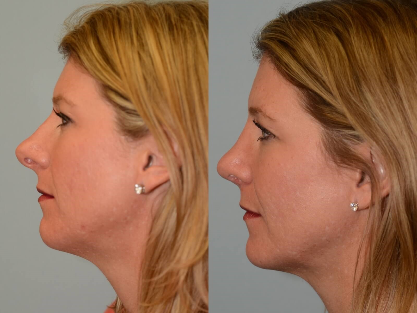Rhinoplasty Before and After 6 months