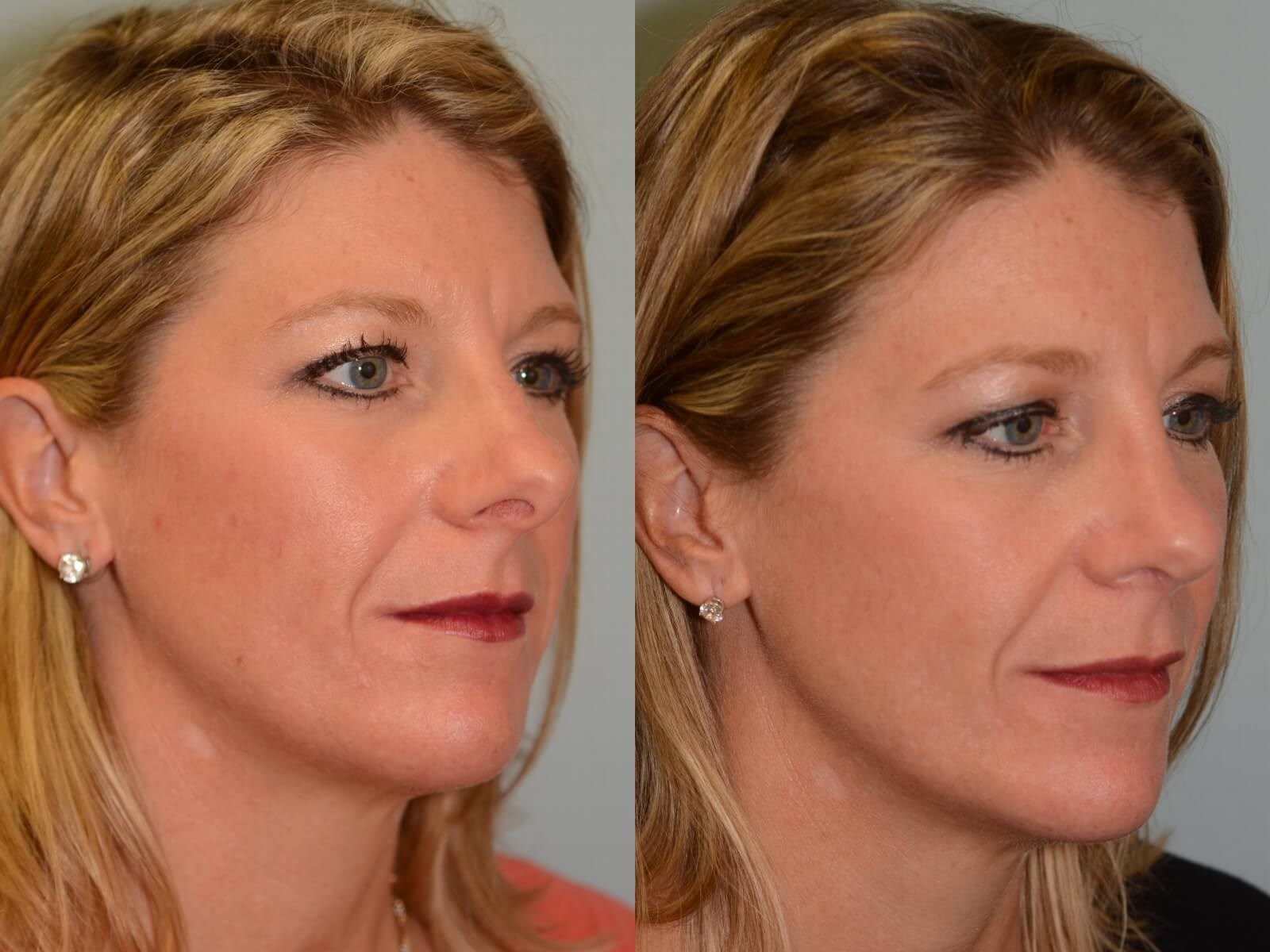 Rhinoplasty Before and After 6 months